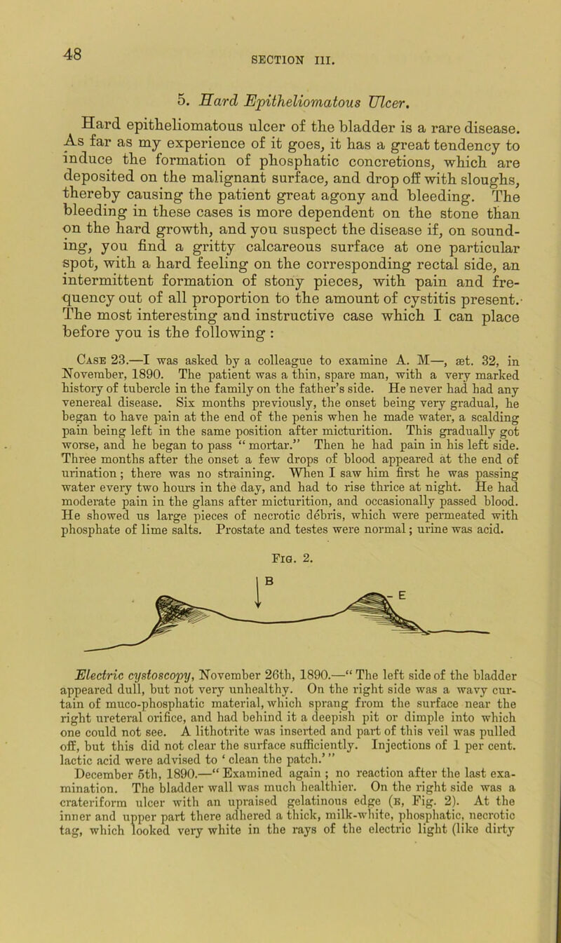 SECTION III. 5. Hard Epitheliomatous Ulcer. Hard epitheliomatous ulcer of the bladder is a rare disease. As far as my experience of it goes, it has a great tendency to induce the formation of phosphatic concretions, which are deposited on the malignant surface, and drop off with sloughs, thereby causing the patient great agony and bleeding. The bleeding in these cases is more dependent on the stone than on the hard growth, and you suspect the disease if, on sound- ing, you find a gritty calcareous surface at one particular spot, with a hard feeling on the coi’responding rectal side, an intermittent formation of stony pieces, with pain and fre- quency out of all proportion to the amount of cystitis present.- The most interesting and instructive case which I can place before you is the following : Case 23.—I was asked by a colleague to examine A. M—, set. 32, in November, 1890. The patient was a thin, spare man, with a very marked history of tubercle in the family on the father’s side. He never had had any venereal disease. Six months previously, the onset being very gradual, he began to have pain at the end of the penis when he made water, a scalding pain being left in the same position after micturition. This gradually got woi-se, and he began to pass “ mortar.” Then he had pain in his left side. Three months after the onset a few drops of blood appeared at the end of urination; there was no straining. When I saw him fimt he was passing water every two hours in the day, and had to rise thrice at night. He had moderate pain in the glans after micturition, and occasionally passed blood. He showed us large pieces of necrotic debris, which were penneated with phosphate of lime salts. Prostate and testes were normal; urine was acid. Fig. 2. Electric cystoscopy, November 26th, 1890.—“ The left side of the bladder appeared dull, but not very unhealthy. On the right side was a wavy cur- tain of muco-phosphatic material, which sprang from the surface near the right ureteral orifice, and had behind it a deepish pit or dimple into which one could not see. A lithotrite was inserted and part of this veil was pulled off, but this did not clear the surface sufficiently. Injections of 1 per cent, lactic acid were advised to ‘ clean the patch.’ ” December 5th, 1890.—“ Examined again ; no reaction after the last exa- mination. The bladder wall was much healthier. On the right side was a crateriform ulcer with an upraised gelatinous edge (k. Fig. 2). At the inner and upper part there adhered a thick, milk-wliite, phosphatic, necrotic tag, which looked very white in the rays of the electric light (like dirty