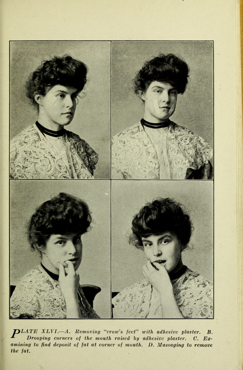 jr}LATE XLVI.—A. Removing “crow’s feet” with adhesive plaster. B. Drooping corners of the mouth raised hy adhesive plaster. C. Ex- amining to find deposit of fat at corner of mouth. D. Massaging to remove the fat.