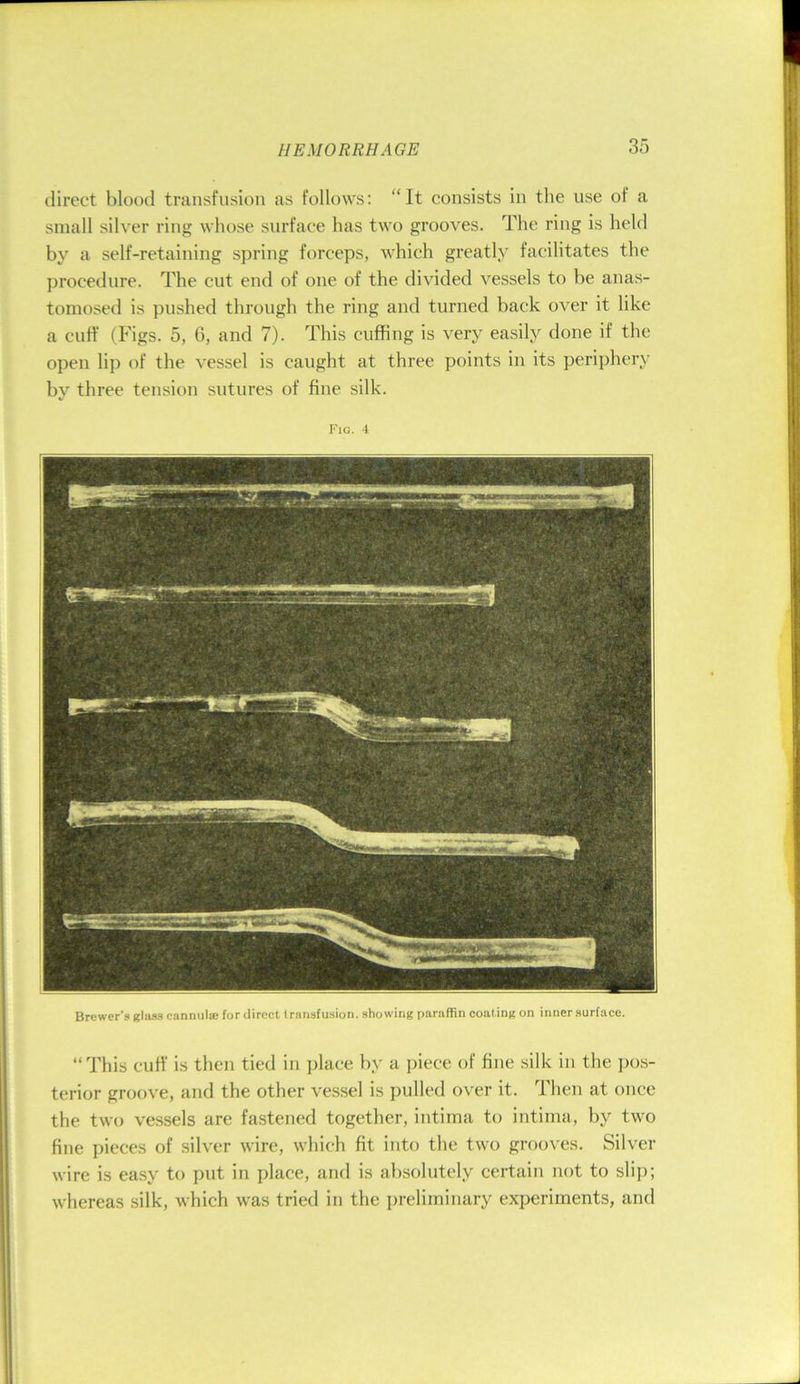direct blood transfusion as follows: “It consists in the use of a small silver ring whose surface has two grooves. The ring is held by a self-retaining spring forceps, which greatly facilitates the procedure. The cut end of one of the divided vessels to be anas- tomosed is pushed through the ring and turned back over it like a Cliff (Figs. 5, 6, and 7). This cuffing is very easily done if the open lip of the vessel is caught at three points in its periphery by three tension sutures of fine silk. Fig. 4 Brewer's glas.s cannula: for direct transfusion, showing paraffin coat ing on inner surface. “This cuff is then tied in place by a piece of fine silk in the ])os- terior groove, and the other vessel is pulled over it. Then at once the two vessels are fastened together, intima to intima, by two fine pieces of silver wire, which fit into the two grooves. Silver wire is easy to put in place, and is absolutely certain not to slip; whereas silk, which was tried in the preliminary experiments, and