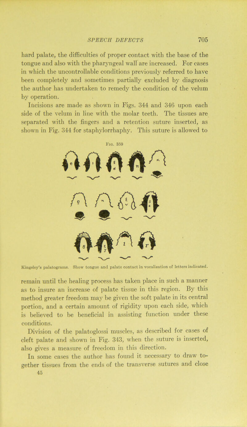 hard palate, the difficulties of proper contact with the base of the tongue and also with the pharyngeal wall are increased. For cases in which the uncontrollable conditions previously referred to have been completely and sometimes partially excluded by diagnosis the author has undertaken to remedy the condition of the velum by operation. Incisions are made as shown in Figs. 344 and 346 upon each side of the velum in line with the molar teeth. The tissues are separated with the fingers and a retention suture inserted, as shown in Fig. 344 for staphylorrhaphy. This suture is allowed to Fig. 359 Kingsley’s palatograms. Show tongue and palate contact in vocalization of letters indicated. remain until the healing process has taken place in such a manner as to insure an increase of palate tissue in this region. By this method greater freedom may be given the soft palate in its central portion, and a certain amount of rigidity upon each side, which is believed to be beneficial in assisting function under these conditions. Division of the palatoglossi muscles, as described for cases of cleft palate and shown in Fig. 343, when the suture is inserted, also gives a measure of freedom in this direction. In some cases the author has found it necessary to draw to- gether tissues from the ends of the transverse sutures and close 45