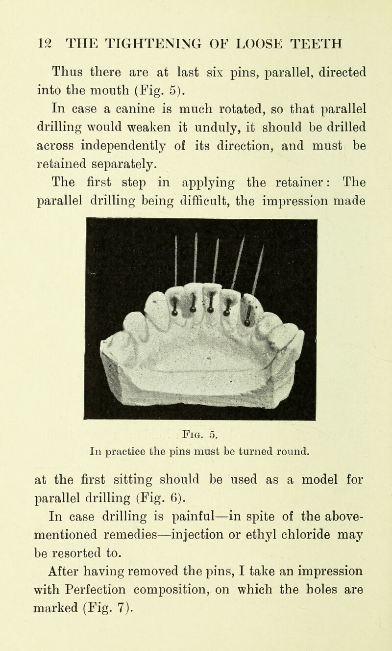 Thus there are at last six pins, parallel, directed into the mouth (Eig. 5). In case a canine is much rotated, so that parallel drilling would weaken it unduly, it should be drilled across independently of its direction, and must be retained separately. The first step in applying the retainer: The parallel drilling being difficult, the impression made Fig. 5. In practice the pins must be turned round. at the first sitting should be used as a model for parallel drilling (Fig. 6). In case drilling is painful—in spite of the above- mentioned remedies—injection or ethyl chloride may be resorted to. After having removed the pins, I take an impression with Perfection composition, on which the holes are marked (Fig. 7).