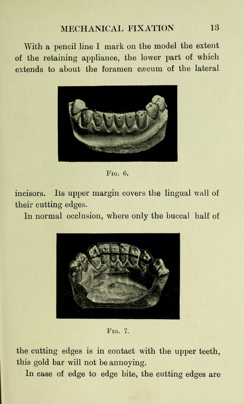 With a pencil line I mark on the model the extent of the retaining appliance, the lower part of which extends to about the foramen caecum of the lateral Fig. 6. incisors. Its upper margin covers the lingual wall of their cutting edges. In normal occlusion, where only the buccal half of Fig. 7. the cutting edges is in contact with the upper teeth, this gold bar will not be annoying. In case of edge to edge bite, the cutting edges are