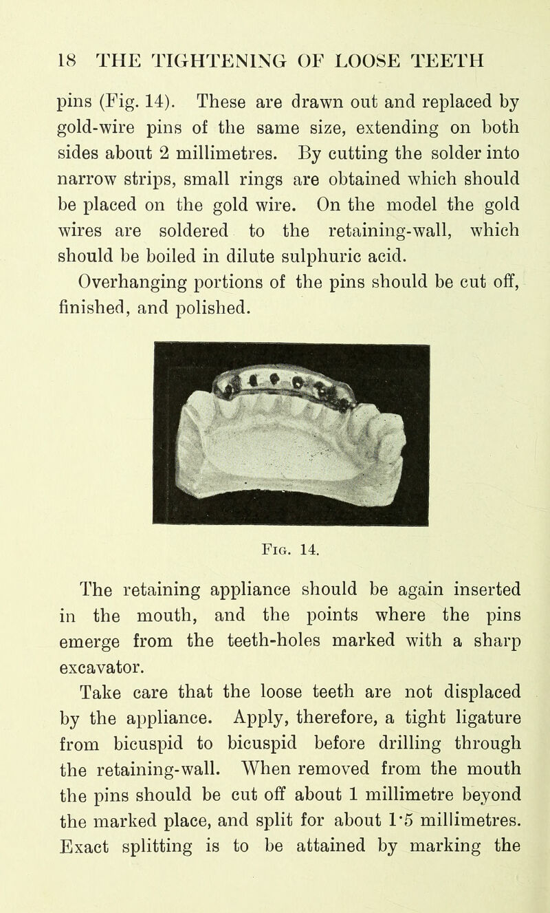 pins (Fig. 14). These are drawn out and replaced by gold-wire pins of the same size, extending on both sides about 2 millimetres. By cutting the solder into narrow strips, small rings are obtained which should be placed on the gold wire. On the model the gold wires are soldered to the retaining-wall, which should be boiled in dilute sulphuric acid. Overhanging portions of the pins should be cut off, finished, and polished. Fig. 14. The retaining appliance should be again inserted in the mouth, and the points where the pins emerge from the teeth-holes marked with a sharp excavator. Take care that the loose teeth are not displaced by the appliance. Apply, therefore, a tight ligature from bicuspid to bicuspid before drilling through the retaining-wall. When removed from the mouth the pins should be cut off about 1 millimetre beyond the marked place, and split for about 1*5 millimetres. Exact splitting is to be attained by marking the