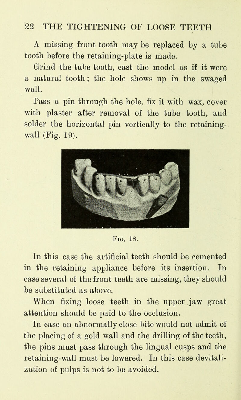 A missing front tooth may be replaced by a tube tooth before the retaining-plate is made. Grind the tube tooth, cast the model as if it were a natural tooth; the hole shows up in the swaged wall. Pass a pin through the hole, fix it with wax, cover with plaster after removal of the tube tooth, and solder the horizontal pin vertically to the retaining- wall (Fig. 19). Fig. 18. In this case the artificial teeth should be cemented in the retaining appliance before its insertion. In case several of the front teeth are missing, they should be substituted as above. When fixing loose teeth in the upper jaw great attention should be paid to the occlusion. In case an abnormally close bite would not admit of the placing of a gold wall and the drilling of the teeth, the pins must pass through the lingual cusps and the retaining-wall must be lowered. In this case devitali- zation of pulps is not to be avoided.