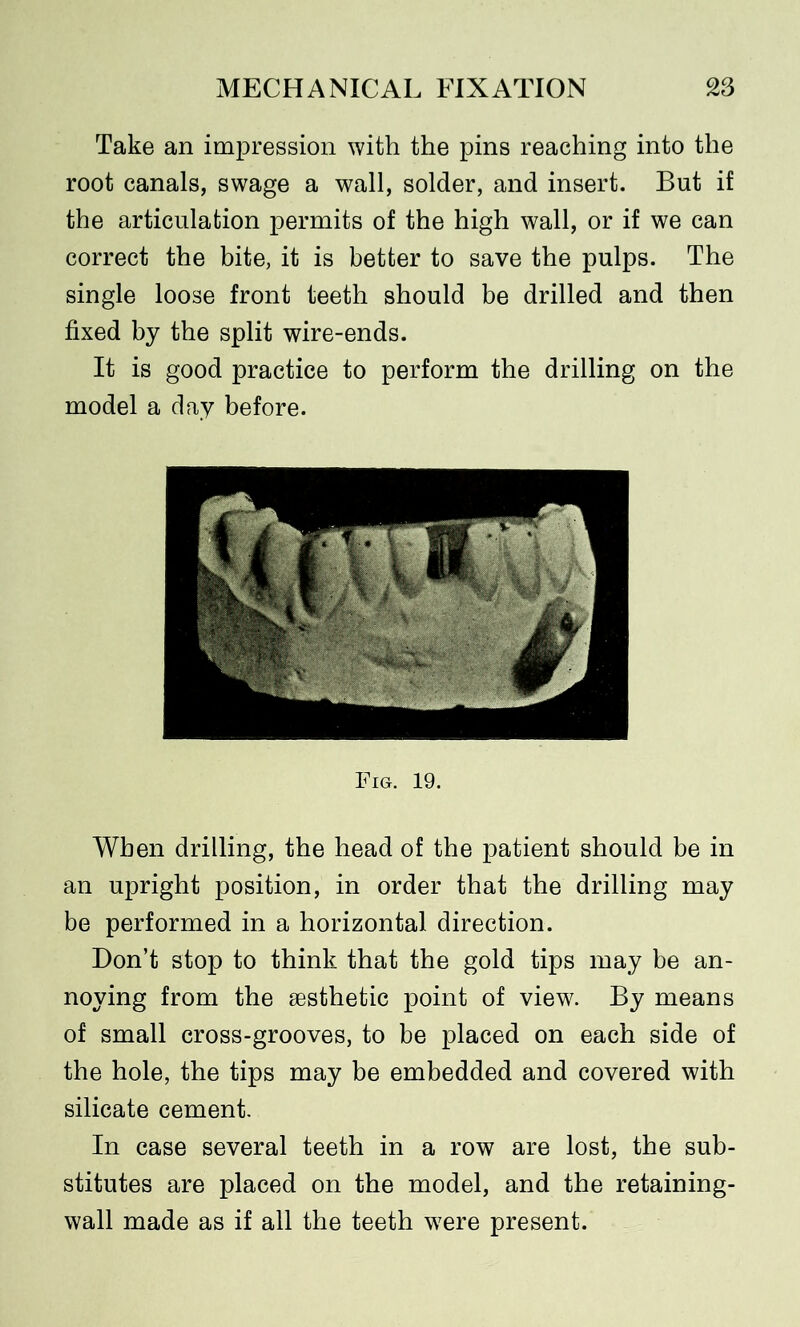 Take an impression with the pins reaching into the root canals, swage a wall, solder, and insert. But if the articulation permits of the high wall, or if we can correct the bite, it is better to save the pulps. The single loose front teeth should be drilled and then fixed by the split wire-ends. It is good practice to perform the drilling on the model a day before. Fig. 19. When drilling, the head of the patient should be in an upright position, in order that the drilling may be performed in a horizontal direction. Don’t stop to think that the gold tips may be an- noying from the sesthetic point of view. By means of small cross-grooves, to be placed on each side of the hole, the tips may be embedded and covered with silicate cement. In case several teeth in a row are lost, the sub- stitutes are placed on the model, and the retaining- wall made as if all the teeth were present.