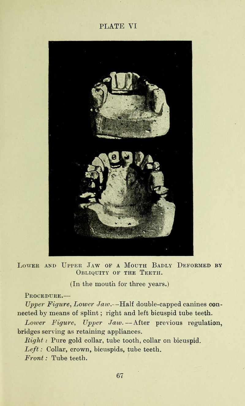 Lower and Upper Jaw of a Mouth Badly Deformed by Obliquity of the Teeth. (In the mouth for three years.) Procedure.— Upper Figure, Lower Jaw.—Half double-capped canines con- nected by means of splint; right and left bicuspid tube teeth. Lower Figure, Upper Jaio.—After previous regulation, bridges serving as retaining appliances. Bight: Pure gold collar, tube tooth, collar on bicuspid. Left: Collar, crown, bicuspids, tube teeth. Front: Tube teeth.