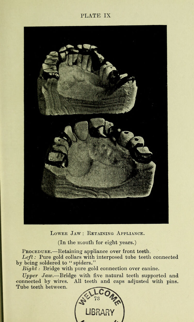 Lower Jaw : Retaining Appliance. (In the mouth for eight years.) Procedure.—Retaining appliance over front teeth. Left: Pure gold collars with interposed tube teeth connected by being soldered to “ spiders.” Bight: Bridge with pure gold connection over canine. Upper Jaw.—Bridge with five natural teeth supported and connected by wires. All teeth and caps adjusted with pins. Tube teeth between.