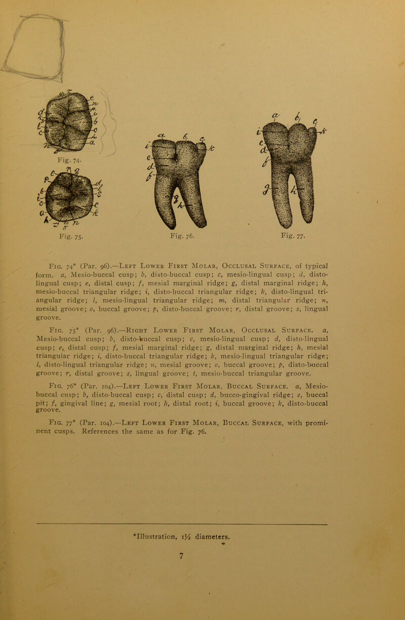 Fig. 75- Fig. 76. Fig. 77. Fig. 74* (Par. 96).—Left Lower First Molar, Occlusal Surface, of typical form, a, Mesio-buccal cusp; b, disto-buccal cusp; c, mesio-lingual cusp; d, disto- lingual cusp; e, distal cusp; f, mesial marginal ridge; g, distal marginal ridge; Ji, mesio-buccal triangular ridge; i, disto-buccal triangular ridge; k, disto-lingual tri- angular ridge; /, mesio-lingual triangular ridge; m, distal triangular ridge; n, mesial groove; 0, buccal groove; p, disto-buccal groove; r, distal groove; s, lingual groove. Fig. 75* (Par. 96).—Right Lower First Molar, Occlusal Surface, a, Mesio-buccal cusp; b, disto-feuccal cusp; c, mesio-lingual cusp; d, disto-lingual cusp; edistal cusp; f, mesial marginal ridge; g, distal marginal ridge; h, mesial triangular ridge; i, disto-buccal triangular ridge; k, mesio-lingual triangular ridge; /, disto-lingual triangular ridge; n, mesial groove; 0, buccal groove; p, disto-buccal groove; r, distal groove; s, lingual groove; t, mesio-buccal triangular groove. Fig. 76* (Par. 104).—Left Lower First Molar, Buccal Surface, a, Mesio- buccal cusp; b, disto-buccal cusp; c, distal cusp; d, bucco-gingival ridge; e, buccal pit; f, gingival line; g, mesial root; h, distal root; i, buccal groove; k, disto-buccal groove. Fig. 77* (Par. 104).—Left Lower First Molar, Buccal Surface, with promi- nent cusps. References the same as for Fig. 76. *Illustration, iJ4 diameters. 7