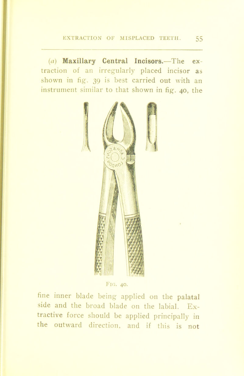 (<i) Maxillary Central Incisors.—The ex- traction of an irregularly placed incisor as shown in fig. 39 is best carried out with an instrument similar to that shown in fig. 40, the Fig. 40. fine inner blade being applied on the palatal side and the broad blade on the labial. Ex- tractive force should be applied principally in the outward direction, and if this is not