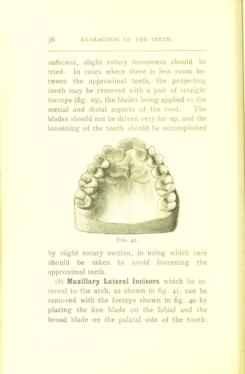 sufficient, slight rotary movement should be tried. In cases where there is less room be- tween the approximal teeth, the projecting tooth may be removed with a pair of straight forceps (fig. 19), the blades being applied to the mesial and distal aspects of the root. The blades should not be driven very far up, and the loosening of the tooth should be accomplished Fig. 41. by slight rotary motion, in using which care should be taken to avoid loosening the approximal teeth. (b) Maxillary Lateral Incisors which lie in- ternal to the arch, as shown in fig. 41, can be removed with the forceps shown in fig. 40 by placing the fine blade on the labial and the broad blade on the palatal side of the tooth.