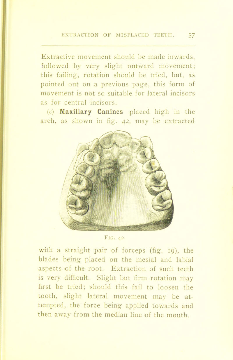 Extractive movement should be made inwards, followed by very slight outward movement; this failing, rotation should be tried, but, as pointed out on a previous page, this form of movement is not so suitable for lateral incisors as for central incisors. (c) Maxillary Canines placed high in the arch, as shown in fig. 42, may be extracted Fig. 42. with a straight pair of forceps (fig. 19), the blades being placed on the mesial and labial aspects of the root. Extraction of such teeth is very difficult. Slight but firm rotation may first be tried; should this fail to loosen the tooth, slight lateral movement may be at- tempted, the force being applied towards and then away from the median line of the mouth.