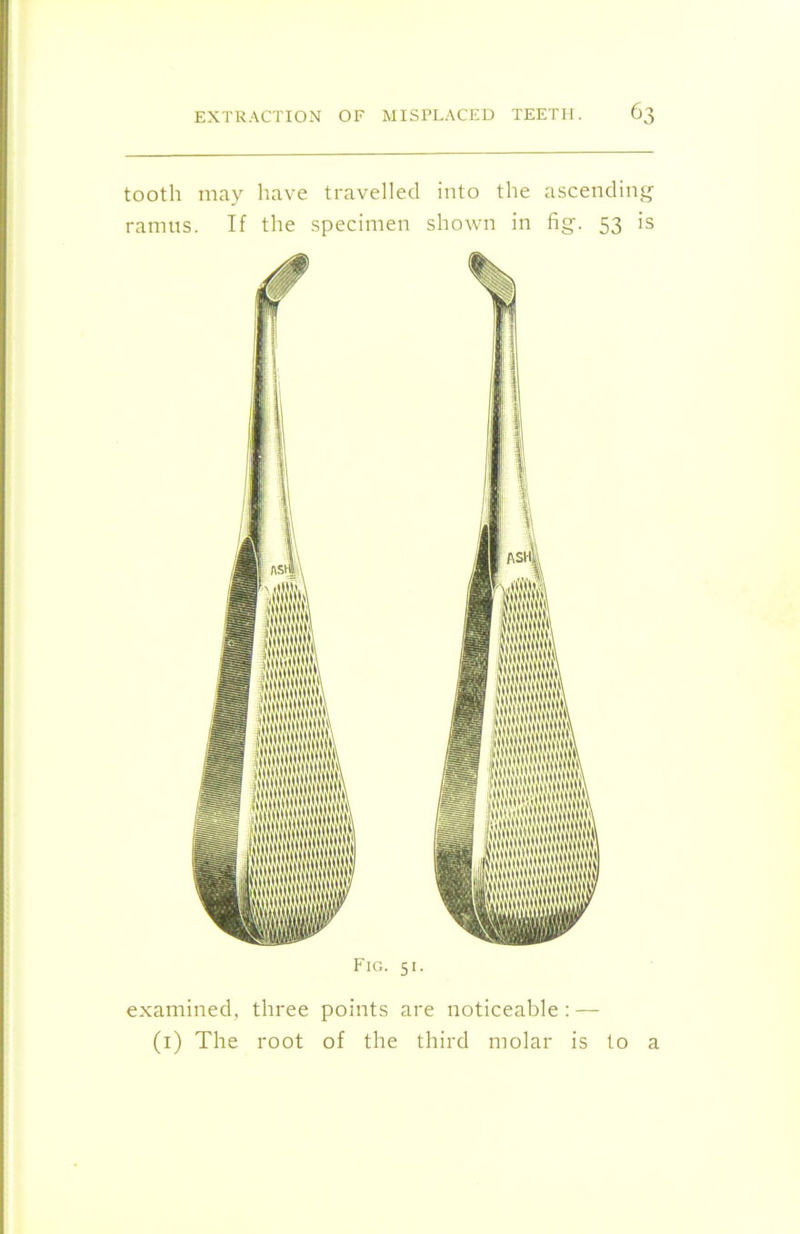 tooth may have travelled into the ascending ramus. If the specimen shown in fig. 53 is Fig. 51. examined, three points are noticeable : — (1) The root of the third molar is to a