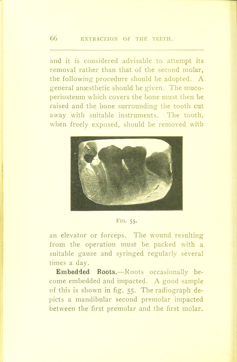 and it is considered advisable to attempt its removal rather than that of the second molar, the following procedure should be adopted. A general anaesthetic should be given. The muco- periosteum which covers the bone must then be raised and the bone surrounding the tooth cut away with suitable instruments. The tooth, when freely exposed, should be removed with Fig. ss. an elevator or forceps. The wound resulting from the operation must be packed with a suitable gauze and syringed regularly several times a day. Embedded Roots.—Roots occasionally be- come embedded and impacted. A good sample of this is shown in fig. 55. The radiograph de- picts a mandibular second premolar impacted between the first premolar and the first molar.