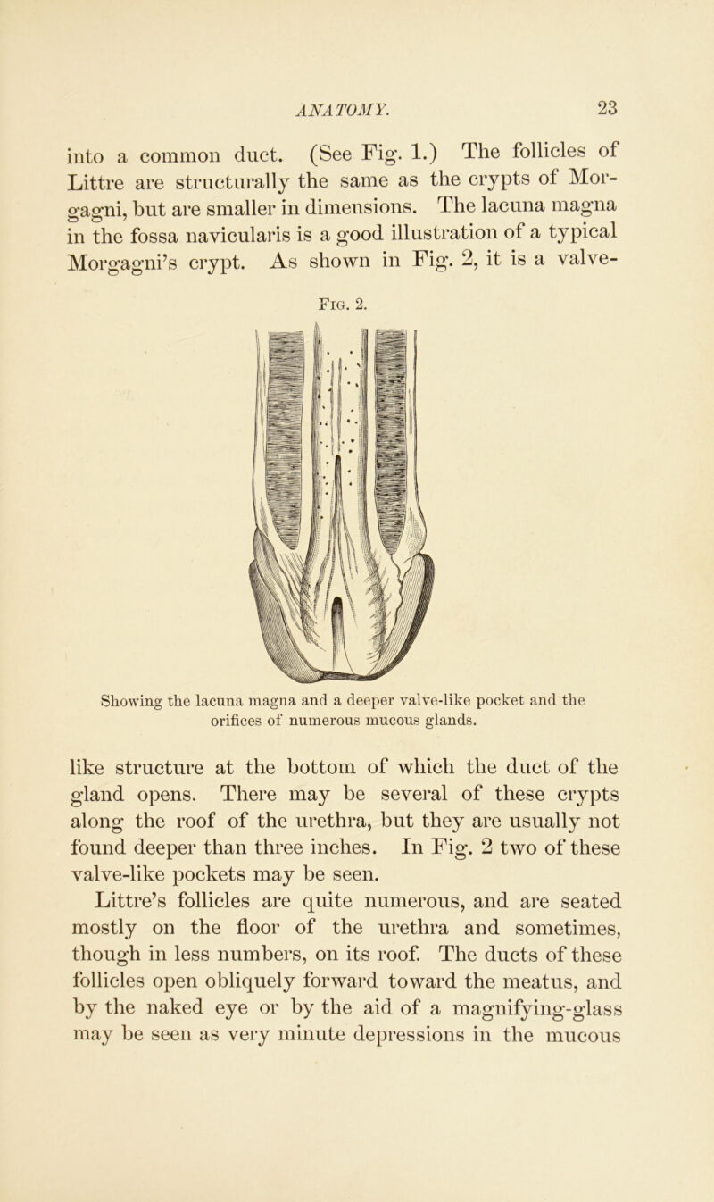 into a common duct. (See Fig. 1.) The follicles of Littre are structurally the same as the crypts of Mor- gagni, but are smaller in dimensions. The lacuna magna in the fossa navicularis is a good illustration of a typical Morgagni’s crypt. As shown in Fig. 2, it is a valve- Fig. 2. Showing the lacuna magna and a deeper valve-like pocket and the orifices of numerous mucous glands. like structure at the bottom of which the duct of the gland opens. There may be several of these crypts along the roof of the urethra, but they are usually not found deeper than three inches. In Fig. 2 two of these valve-like pockets may be seen. Littre’s follicles are quite numerous, and are seated mostly on the floor of the urethra and sometimes, though in less numbers, on its roof. The ducts of these follicles open obliquely forward toward the meatus, and by the naked eye or by the aid of a magnifying-glass may be seen as very minute depressions in the mucous