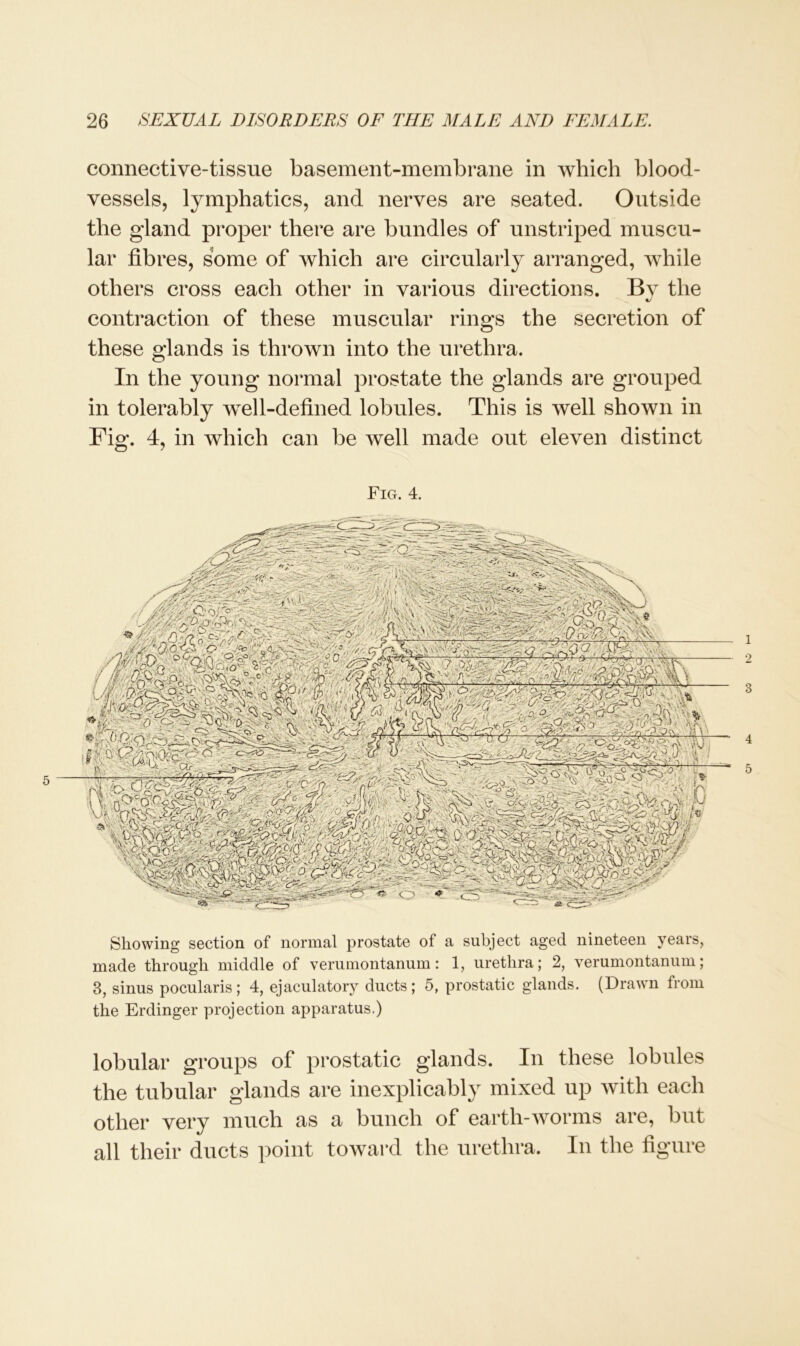 connective-tissue basement-membrane in which blood- vessels, lymphatics, and nerves are seated. Outside the gland proper there are bundles of unstriped muscu- lar fibres, some of which are circularly arranged, while others cross each other in various directions. By the contraction of these muscular rings the secretion of these glands is thrown into the urethra. In the young normal prostate the glands are grouped in tolerably well-defined lobules. This is well shown in Fig. 4, in which can be well made out eleven distinct Fig. 4. ig pi Showing section of normal prostate of a subject aged nineteen years, made through middle of verumontanum: 1, urethra; 2, verumontanum; 3, sinus pocularis; 4, ejaculatory ducts ; 5, prostatic glands. (Drawn from the Erdinger projection apparatus.) lobular groups of prostatic glands. In these lobules the tubular glands are inexplicably mixed up with each other very much as a bunch of earth-worms are, but all their ducts point toward the urethra. In the figure