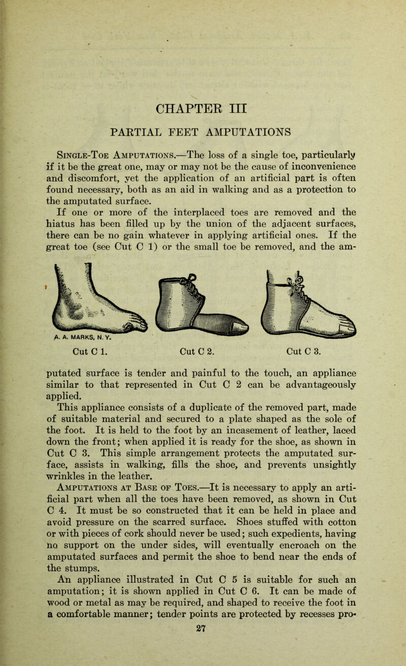 PAKTIAL FEET AMPUTATIONS Single-Toe Amputations,—The loss of a single toe, particularly if it be the great one, may or may not be the cause of inconvenience and discomfort, yet the application of an artificial part is often found necessary, both as an aid in walking and as a protection to the amputated surface. If one or more of the interplaced toes are removed and the hiatus has been filled up by the union of the adjacent surfaces, there can be no gain whatever in applying artificial ones. If the great toe (see Cut C 1) or the small toe be removed, and the am- Cut C 1. Cut C 2. Cut C 3. putated surface is tender and painful to the touch, an appliance similar to that represented in Cut C 2 can be advantageously applied. This appliance consists of a duplicate of the removed part, made of suitable material and secured to a plate shaped as the sole of the foot. It is held to the foot by an incasement of leather, laced down the front; when applied it is ready for the shoe, as shown in Cut C 3. This simple arrangement protects the amputated sur- face, assists in walking, fills the shoe, and prevents unsightly wrinkles in the leather. Amputations at Base of Toes.—It is necessary to apply an arti- ficial part when all the toes have been removed, as shown in Cut C 4. It must be so constructed that it can be held in place and avoid pressure on the scarred surface. Shoes stuffed with cotton or with pieces of cork should never be used; such expedients, having no support on the under sides, will eventually encroach on the amputated surfaces and permit the shoe to bend near the ends of the stumps. An appliance illustrated in Cut C 5 is suitable for such an amputation; it is shown applied in Cut C 6. It can be made of wood or metal as may be required, and shaped to receive the foot in a comfortable manner; tender points are protected by recesses pro-