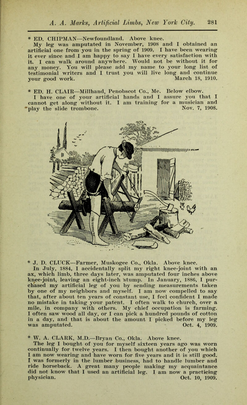 * ED. CHIPMAN—Newfoundland. Above knee. My leg was amputated in November, 1908 and I obtained an artificial one from you in the spring of 1909. I have been wearing it ever since and I am happy to say I have every satisfaction with it. I can walk around anywhere. Would not be without it for any money. You will please add my name to your long list of testimonial writers and I trust you will live long and continue your good work. March 18, 1910. * ED. H. CLAIE—Millhand, Penobscot Co., Me. Below elbow. I have one of your artificial hands and I assure you that I cannot get along without it. I am training for a musician and •play the slide trombone. Nov. 7, 1908. * J. D. CLUCK—Farmer, Muskogee Co., Okla. Above knee. In July, 1884, I accidentally split my right knee-joint with an ax, which limb, three days later, was amputated four inches above knee-joint, leaving an eight-inch stump. In January, 1886, I pur- chased my artificial leg of you by sending measurements taken by one of my neighbors and myself. I am now compelled to say that, after about ten years of constant use, I feel confident I made no mistake in taking your patent. I often walk to church, over a mile, in company with others. My chief occupation is farming. I often saw wood all day, or I can pick a hundred pounds of cotton in a day, and that is about the amount I picked before my leg was amputated. Oct. 4, 1909. * W. A. CLAEK, M.D.—Bryan Co., Okla. Above knee. The leg I bought of you for myself sixteen years ago was worn continually for twelve years. I then bought another of you which I am now wearing and have worn for five years and it is still good. I was formerly in the lumber business, had to handle lumber and ride horseback. A great many people making my acquaintance did not know that I used an artificial leg. I am now a practicing physician. Oct. 10, 1909.