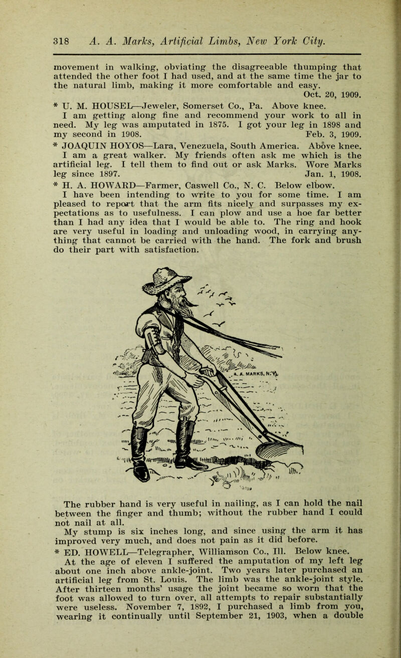 movement in w^alking, obviating the disagreeable thumping that attended the other foot I had used, and at the same time the jar to the natural limb, making it more comfortable and easy. Oct. 20, 1909. * U. M. HOUSEL—Jeweler, Somerset Co., Pa. Above knee. I am getting along fine and recommend your work to all in need. My leg was amputated in 1875. I got your leg in 1898 and my second in 1908. Feb. 3, 1909. * JOAQUIN HOYOS—Lara, Venezuela, South America. Above knee. I am a great walker. My friends often ask me which is the artificial leg. I tell them to find out or ask Marks. Wore Marks leg since 1897. Jan. 1, 1908. * H. A. HOWAED—Farmer, Caswell Co., N. C. Below elbow. I have been intending to write to you for some time. I am pleased to report that the arm fits nicely and surpasses my ex- pectations as to usefulness. I can plow and use a hoe far better than I had any idea that I would be able to. The ring and hook are very useful in loading and unloading wood, in carrying any- thing that cannot be carried with the hand. The fork and brush do their part with satisfaction. The rubber hand is very useful in nailing, as I can hold the nail between the finger and thumb; without the rubber hand I could not nail at all. My stump is six inches long, and since using the arm it has improved very much, and does not pain as it did before. * ED. HOWELL—Telegrapher, Williamson Co., 111. Below knee. At the age of eleven I suffered the amputation of my left leg about one inch above ankle-joint. Two years later purchased an artificial leg from St. Louis. The limb was the ankle-joint style. After thirteen months’ usage the joint became so worn that the foot was allowed to turn over, all attempts to repair substantially were useless. November 7, 1892, I purchased a limb from you, wearing it continually until September 21, 1903, when a double