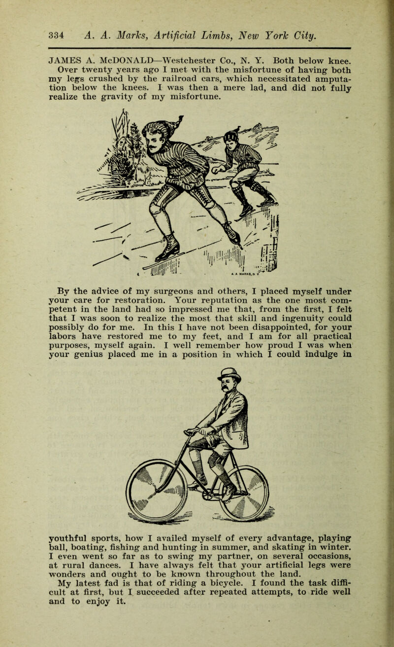 JAMES A. McDonald—Westchester Co., N. Y. Both below knee. Over twenty years ago I met with the misfortune of having both my legs crushed by the railroad cars, which necessitated amputa- tion below the knees. I was then a mere lad, and did not fully realize the gravity of my misfortune. By the advice of my surgeons and others, I placed myself under your care for restoration. Your reputation as the one most com- petent in the land had so impressed me that, from the first, I felt that I was soon to realize the most that skill and ingenuity could possibly do for me. In this I have not been disappointed, for your labors have restored me to my feet, and I am for all practical purposes, myself again. I well remember how proud I was when your genius placed me in a position in which I could indulge in youthful sports, how I availed myself of every advantage, playing ball, boating, fishing and hunting in summer, and skating in winter. I even went so far as to swing my partner, on several occasions, at rural dances. I have always felt that your artificial legs were wonders and ought to be known throughout the land. My latest fad is that of riding a bicycle. I found the task diffi- cult at first, but I succeeded after repeated attempts, to ride well and to enjoy it.
