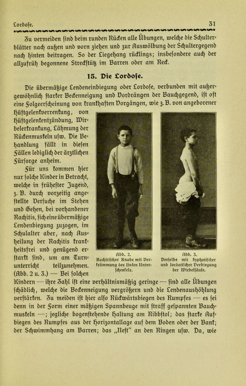 Corbofe. 3u uermeiben finb beim runben Küden alle Übungen, roelcge bie Scgulter5 blätter nad) äugen unb oorn 3teljen unb 3ur Hustoölbung ber Scgultergegenb nad) hinten beitragen. So ber £iegegang rüdlings; insbefonbere aud) ber all3ufrüf) begonnene Stredftüg im Barren ober am Ked. 15. Die toröofe. Die übermägige Senbeneinbiegung ober £orbofe, oerbunben mit auger5 geroögnlid) ftarfer Bedenneigung unb Dorbrängen ber Baucggegenb, ift oft eine $olgeerfcgeinung non frantgaften Vorgängen, toie 3.B. oon angeborener f^üftgelenfuerrentung, non f}üftgelenlent3ünbung, IDir= belerfrantung, £ägntung ber Küdenmusteln ufax Die Be= ganblung fällt in biefen fällen lebiglid) ber är3tlicgen $ürforge anheim. $ür uns tommen gier nur folcge Kinber in Betracgt, roeld)e in frügefter 3ugenb, 3. B. burd) Dor3eitig ange= ftellte Derfucge im Stegen unb (Segen, bei oorganbener Kacgitis, ficgeineübermägige £enbenbiegung 3U3ogen, im Scgulalter aber, nacg Huss geilung ber Kacgitis tränt5 geitsfrei unb genügenb ers ftartt finb, um am (Turn5 unterricgt teigjunegmen. (Hbb. 2 u. 3.) — Bei folcgen «t Kittbern — igre 3agl ift eine oergältnismägig geringe — finb alle Übungen fcgäblicg, roelcge bie Bedenneigung oergrögern unb bie £enbenausgöglung oerftärten. 3u meiben ift gier alfo Küdroärtsbiegen bes Kumpfes — es fei benn in ber 5omt einer mägigen Spannbeuge mit ftraff gefpannten Baud)5 mustein —; jeglicge bogenftegenbe Haltung am Kibbftol; bas ftarte Huf5 biegen bes Kumpfes aus ber t)ori3ontallage auf bem Boben ober ber Bant; ber Scgroimmgang am Barren; bas „Heft an ben Kingen ufto. Da, roie flbb. 2. Harf|itifcf}er Kttabc mit üer= frümmung bes Iirtfen Unter= jd]enfels. Hbb. 3. Derjelbe mit fqptjotifdier unb lorbottfcfyer Derbiegung ber IDirbelfciuIe.