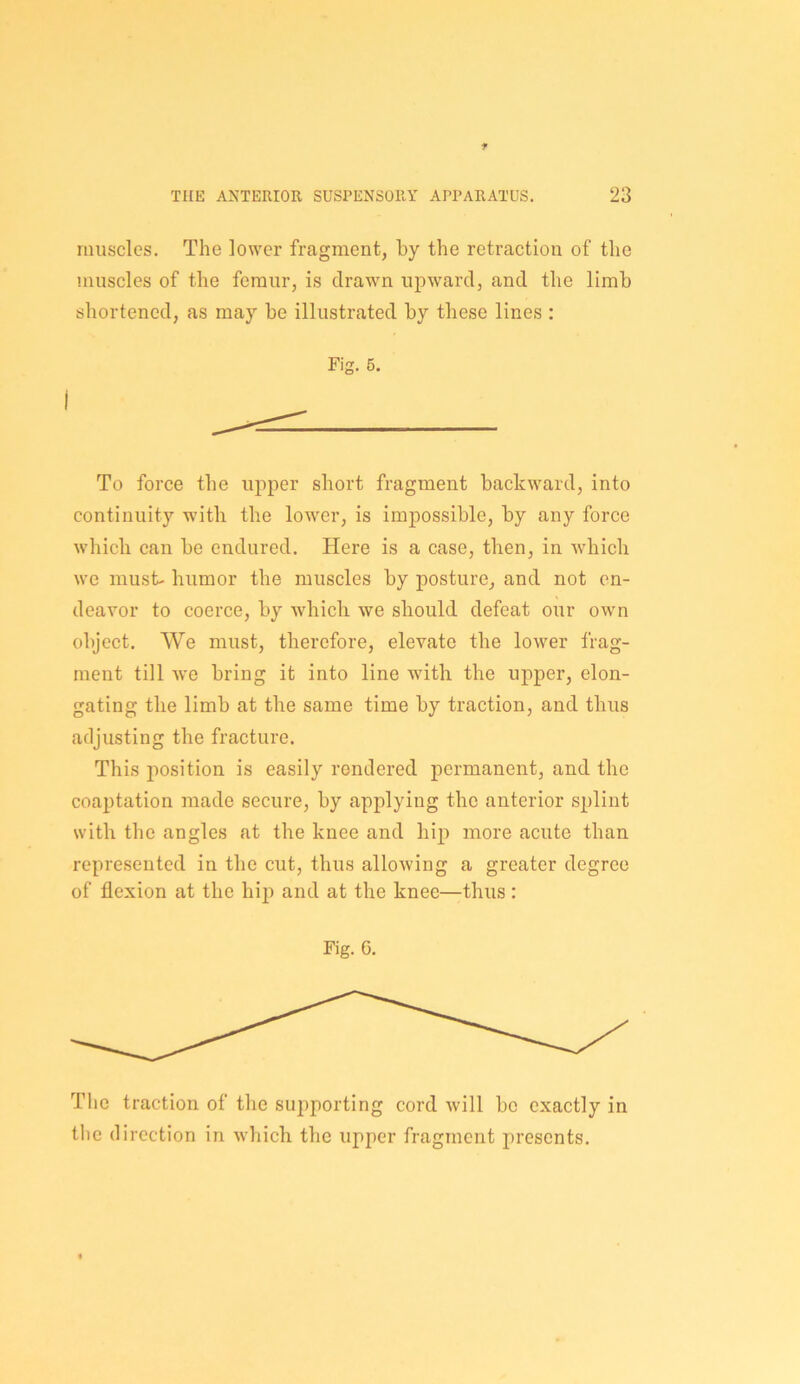 muscles. The lower fragment, by the retraction of the muscles of the femur, is drawn upward, and the limb shortened, as may be illustrated by these lines : Fig. 5. To force the upper short fragment backward, into continuity with the lower, is impossible, by any force which can be endured. Here is a case, then, in which we must- humor the muscles by posture, and not en- deavor to coerce, by which we should defeat our own objeet. We must, therefore, elevate the lower frag- ment till we bring it into line with the upper, elon- gating the limb at the same time by traction, and thus adjusting the fracture. This imsition is easily rendered permanent, and the coaptation made secure, by applying the anterior splint with the angles at the knee and hip more acute than represented in the cut, thus allowing a greater degree of flexion at the hij) and at the knee—thus : Fig. 6. Tlie traction of the sui^porting cord will be exactly in tlie direction in which the upper fragment presents.