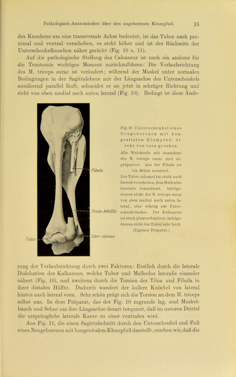 Pathologisch-Anatomisches über den angeborenen Klumpfuß. 16 des Knochens um eine transversale Achse bedeutet, ist das Tuber nach pro- ximal lind ventral verschoben, es steht höher und ist der Rückseite der Unterschenkelknochen näher gerückt (Fig. 10 u.. 11). Auf die pathologische Stellung des Calcaneus ist noch ein anderes für die Tenotoinie wichtiges Moment zurückzuführen: Die Verlaufsrichtung des M. triceps snrae ist verändert; während der Muskel unter normalen Bedingungen in der Sagittalebene mit der Längsachse des Unterschenkels annähernd parallel läuft, schneidet er sie jetzt in schräger Richtung und zieht von oben medial nach unten lateral (Fig. 10). Bedingt ist diese Ände- Talujs Fiiuhx TcndoAchUUs Tuber calcand Fig. 10. Unter Schenkel eines Neugeborenen mit kon- genitalem Klumpfuß; di- rekt von vorn gesehen. Alle Weichteile mit Ausnahme des M. triceps surae sind ab- präpariert. Aus der Fibula ist ein Stück reseziert. Das Tuber calcanei ist stark nach lateral verschoben, dem Malleolus lateralis benachbart. Infolge- dessen zieht der M. triceps surae von oben medial nach unten la- teral, also schräg zur Uiiter- schenkelachse. Der Kalkaneus ist stark plantarflektiert; infolge- dessen steht das Tuber sehr hoch. (Eigenes Präparat.) iTing der Verlaufsrichtung durch zwei Faktoren: Erstlich durch die laterale Dislokation des Kalkaneus, welche Tuber und Malleolus lateralis einander nähert (Fig. 10), und zweitens durch die Torsion der Tibia und Fibula in ihrer distalen Hälfte. Dadurch wandert der äußere Knöchel von lateral hinten nach lateral vorn. Sehr schön prägt sich die Torsion an dem M. triceps selbst aus. In dem Präparat, das der Fig. 10 zugrunde lag, sind Muskel- bauch und Sehne um ihre Längsachse derart torquiert, daß im unteren Drittel die ursprüngliche laterale Kante zu einer ventralen wird. Aus Fig. 11, die einen Sagittalschnitt durch den Unterschenkel und Fuß eines Neugeborenen mit kongenitalem Klumpfuß darstellt, ersehen wir, daß die