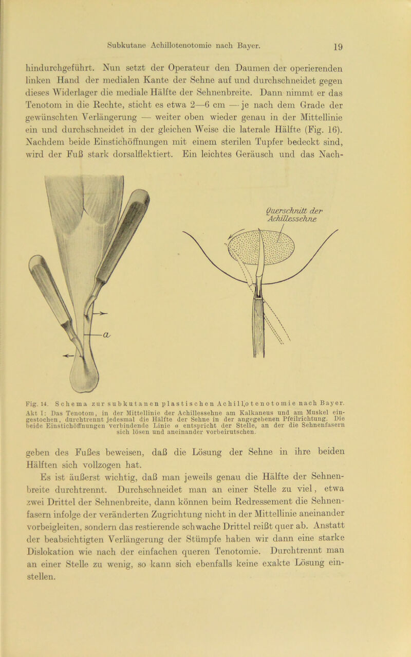 hindurchgeführt. Nun setzt der Operateur den Daumen der operierenden linken Hand der medialen Kante der Sehne auf und durchschneidet gegen dieses Widerlager die mediale Hälfte der Sehnenbreite. Dann nimmt er das Tenotom in die Rechte, sticht es etwa 2—G cm —je nach dem Grade der gewünschten Verlängerung — weiter oben wieder genau in der Mittellinie ein und durchschneidet in der gleichen Weise die laterale Hälfte (Fig. 16). Nachdem beide Einstichöffnungen mit einem sterilen Tupfer bedeckt sind, wird der Fuß stark dorsalflektiert. Ein leichtes Geräusch und das Nach- Fig. 14. Schema zur subkutanen plastischen Achill.otenotomie nach Bayer. .\kt I: Das Tenotom, in der Mittellinie der Achillessehne am Kalkaneus und am Muskel eiu- gestochen, durch trennt jedesmal die Hälfte der Sehne in der angegebenen Pfeilrichtung. Die beide Einstichöffnungen verbindende Linie a entspricht der Stelle, an der die Sehnenfasern sich lösen und aneinander vorbeirutschen. geben des Fußes beweisen, daß die Lösung der Sehne in ihre beiden Hälften sich vollzogen hat. Es ist äußerst wichtig, daß man jeweils genau die Hälfte der Sehnen- breite durchtrennt. Durchschneidet man an einer Stelle zu viel, etwa zwei Drittel der Sehnenbreite, dann können beim Redressement die Sehnen- fasern infolge der veränderten Zugrichtung nicht in der Mittellinie aneinander vorbeigleiten, sondern das restierende schwache Drittel reißt quer ab. Anstatt der beabsichtigten Verlängerung der Stümpfe haben wir dann eine starke Dislokation wie nach der einfachen queren Tenotomie. Durchtrennt man an einer Stelle zu wenig, so kann sich ebenfalls keine exakte Lösung ein- stellen.