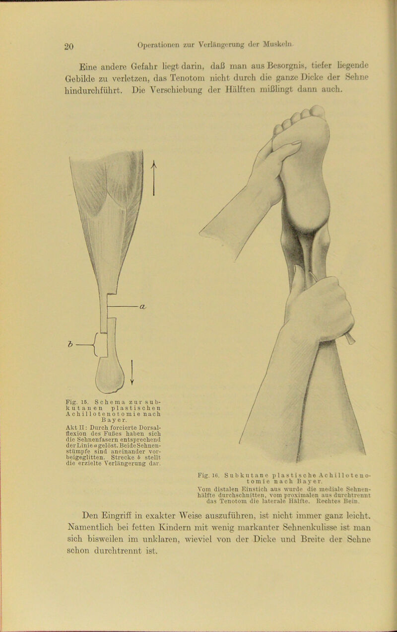 Eine andere Gefalir liegt darin, daß man aus Besorgnis, tiefer liegende Gebilde zu verletzen, das Tenotom nicht durch die ganze Dicke der Sehne hindurchführt. Die Verschiebung der Hälften mißlingt dann auch. Fig. 15. S c h e raa z u r sub- kutanen plastischen Achillotenotomie nach Bayer. Akt II: Durch forcierte Dorsal- flexion des Fußes haben sich die Sehnenfasern entsprechend der Linie a gelöst. BeideSehnen- stümpfe sind aneinander vor- beigeglitten. Strecke b stellt die erzielte Verlängerung dar. Fig. 16. Subkutane plastische Achilloteno- tomie nach Bayer. Vom distalen Einstich aus wurde die mediale Sehnen- hiilfte durchschnitten, vom proximalen aus durchtrennt das Tenotom die laterale Hälfte. Rechtes Bein, Den Eingriff in exakter Weise auszuführen, ist nicht immer ganz leicht. Namentlich bei fetten Kindern mit wenig markanter Sehnenkulisse ist man sich bisweilen im unklaren, wieviel von der Dicke und Breite der Sehne schon durchtrennt ist.