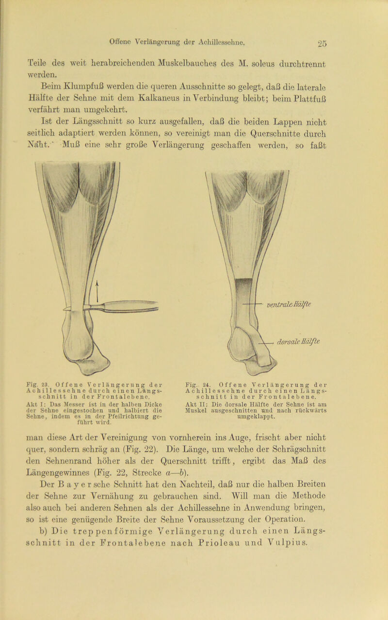 Teile des weit lierabreicheaden Muskelbauches des M. soleus durchtrennt werden. Beim Klumpfuß werden die queren Ausschnitte so gelegt, daß die laterale Hälfte der Sehne mit dem Kalkaneus in Verbindung bleibt; beim Plattfuß verfährt man umgekehrt. Ist der Längsschnitt so kurz ausgefallen, daß die beiden Lappen nicht seitlich adaptiert werden können, so vereinigt man die Querschnitte durch Na'ht. ■ Muß eine sehr große Verlängerung geschaffen werden, so faßt Fig. 23. Offene Verlängerung der Achillessehne durch einen Längs- schnitt in der Frontalebene. Akt 1: Das Messer ist in der halben Dicke der Sehne eingestochen und halbiert die Sehne, indem es in der Pfeilrichtimg ge- führt wird. Fig. 24. Offene Verlängerung der Achillessehne durch einen Längs- schnitt in der Froutalebene. Akt II: Die dorsale Hälfte der Sehne ist am Muskel ausgeschnitten und nach rückwärts umgeklappt. man diese Art der Vereinigung von vornherein ins Auge, frischt aber nicht quer, sondern schräg an (Fig. 22). Die Länge, um welche der Schrägschnitt den Sehnenrand höher als der Querschnitt trifft, ergibt das Maß des Längengewinnes (Fig. 22, Strecke a—h). Der Bayer sehe Schnitt hat den Nachteil, daß nur die halben Breiten der Sehne zur Vernähung zu gebrauchen sind. Will man die Methode also auch bei anderen Sehnen als der Achillessehne in Anwendung bringen, so ist eine genügende Breite der Sehne Voraussetzung der Operation. b) Die trep pen förmige Verlängerung durch einen Längs- schnitt in der Frontalebene nach Prioleau und Vulpius.