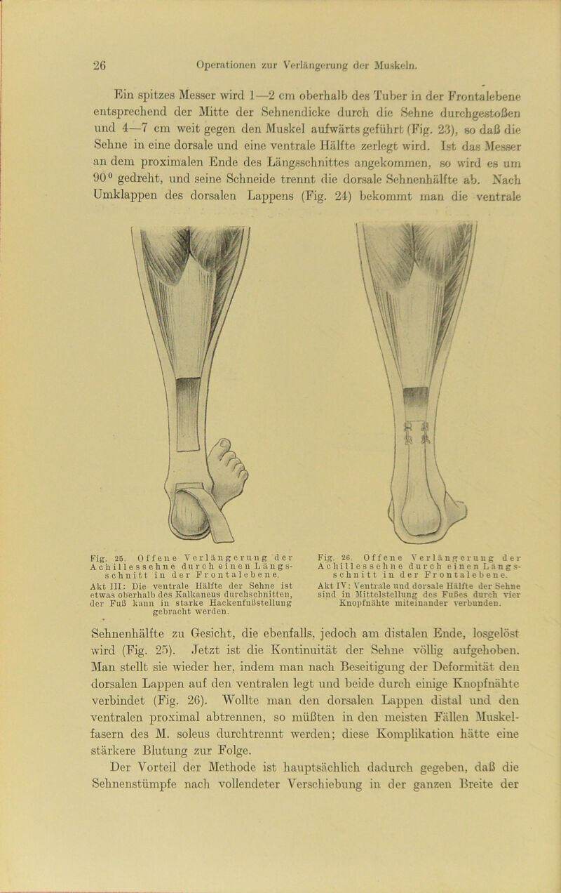 Ein spitzes Messer wird 1—2 cm oberhalb des Tuber in der Frontalebene entsjirecliend der Mitte der Sehnendicke durch die Sehne durchgestoßen und 4—7 cm weit gegen den Muskel aufwärts geführt (Fig, 23), so daß die Sehne in eine dorsale und eine ventrale Hälfte zerlegt wird. Ist das Messer an dem proximalen Ende des Längsschnittes angekommen, so wird es um 90 ° gedreht, und seine Schneide trennt die dorsale Sehnenhälfte ab. Nach Umklappen des dorsalen Lappens (Fig. 24) bekommt man die ventrale rig. 26. Offene Verlängerung cl e r Achillessehne durch einen Längs- schnitt in der Frontalehene. Akt III: Die ventrale Hälfte der Sehne ist etwas oberhalb des Kalkaneus durchschnitten, der Fuß kann in starke Hackenfußstellung gebracht werden. Fig. 26. Offene Verlängerung der Achillessehne durch einen Längs- schnitt in der Frontalebene. Akt IV: Ventrale und dorsale Hälfte der Sehne sind in Mittelstellung des Fußes durch vier Knopfnähte miteinander verbunden. Sehnenhälfte zu Gesicht, die ebenfalls, jedoch am distalen Ende, losgelöst wird (Fig. 25). Jetzt ist die Kontinuität der Sehne völhg aufgehoben. Man stellt sie Avieder her, indem man nach Beseitigung der Deformität den dorsalen Lappen auf den ventralen legt und beide durch einige Knopfnähte verbindet (Fig. 26). Wollte man den dorsalen Lappen distal und den ventralen proximal abtrennen, so müßten in den meisten Fällen Muskel- fasern des M. soleus durch trennt werden; diese Komplikation hätte eine stärkere Blutung zur Folge. Der Vorteil der Methode ist hauptsächlich dadurch gegeben, daß die Sehnenstümpfe nach vollendeter Verschiebung in der ganzen Breite der