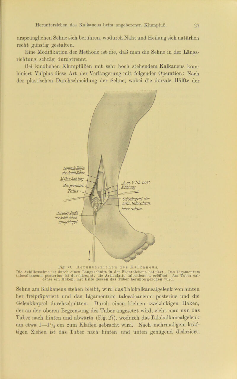 ’irsprüngliclieu Seime sich berühren, wodurch Naht und Heilung sich natürlich recht günstig gestalten. Eine Modifikation der Methode ist die, daß man die Sehne in der Längs- richtung schräg durchtrennt. Bei Icindlichen Klumpfüßen mit sehr hoch stehendem Kalkaneus kom- biniert Vulpius diese Art der Verlängerung mit folgender Operation: Nach der plastischen Durchschneidung der Sehne, wobei die dorsale Hälfte der Fig. 27. He runter ziehen des Kalkaneus. Die Achillessehne ist durch einen Längsschnitt in der Frontalebene halbiert. Das Ligamentum talocalcaneum posterius ist durchtrennt, die Articulatio talocalcanea eröffnet. Am Tuber cal- canei ein Haken, mit Hilfe dessen das Tuber heriintergezogen wird. Sehne am Kalkaneus stehen bleibt, wird das Talokalkanealgelenk von hinten her freipräpariert und das Ligamentum talocalcaneum posterius und die Gelenkkapsel durchschnitten. Durch einen kleinen zweizinlvigen Haken, der an der oberen Begrenzung des Tuber angesetzt wird, zieht man nun das Tuber nach hinten und abwärts (Fig. 27), wodurch das Talokalkanealgelenk um etwa 1—IV2 cm zum Klaffen gebracht wird. Nach mehrmaligem kräf- tigen Ziehen ist das Tuber nach hinten und unten genügend disloziert. dar. derA lU