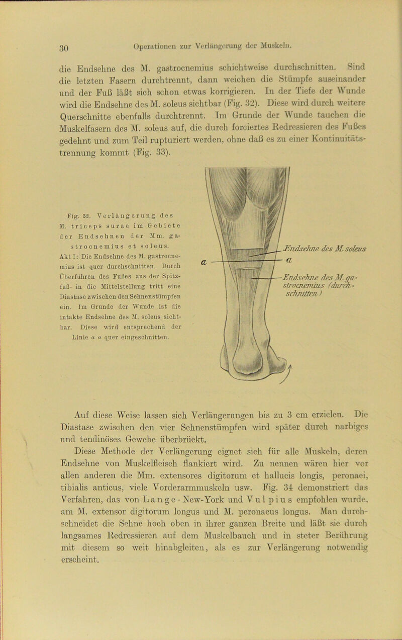 die Endseline des M. gastroenemius scliichtweise durchschnitten. Sind die letzten Fasern durclitrennt, dann weichen die Stümpfe auseinander und der Fuß läßt sich schon etwas korrigieren. In der Tiefe der Wunde wird die Endsehne des M. soleus sichtbar (Fig. 32). Die.«e wird durch weitere Querschnitte ebenfalls durchtrennt. Im Grunde der Wunde tauchen die Muskelfasern des M. soleus auf, die durch forciertes Kedre.ssieren des Fußes gedehnt und zum Teil rupturiert werden, ohne daß es zu einer Kontinuitäts- trennung kommt (Fig. 33). Fig. 32. Verlängerung des M. trieeps surae im Gebiete der End sehnen der Mm. ga- st roonemius et soleus. Akt I; Die Endsehne des M. gastroene- mius ist quer durchschnitten. Durch Überführen des Fußes aus der Spitz- fuß- in die Mittelstellung tritt eine Diastase zwisehen den Sehnenstümpfen ein. Im Grunde der Wunde ist die intakte Endsehne des M. soleus sicht- bar. Diese wird entsprechend der Linie a a quer eingeschnitten. Auf diese Weise lassen sich Verlängerungen bis zu 3 cm erzielen. Die Diastase zwischen den vier Sehnenstümpfen wird später durch narbiges und tendinöses Gewebe überbrückt. Diese Methode der Verlängerung eignet sich für alle i\Iuskeln, deren Endsehne von Muskelfleisch flanlciert wird. Zu nennen wären hier vor allen anderen die Mm. extensores digitorum et hallucis longis, peronaei, tibiahs anticus, viele Vorderarmmuskeln usw. Fig. 31 demonstriert das Verfahren, das von Lange- New-York und V u 1 p i u s empfohlen ^vu^de. am M. extensor digitorum longus und M. peronaeus longus. Man durch- schneidet die Sehne hoch oben in ihrer ganzen Breite und läßt sie durch langsames Redressieren auf dem Muskelbauch und in steter Berührung mit diesem so weit hinabgleiten, als es zur Verlängerung notwendig erscheint.