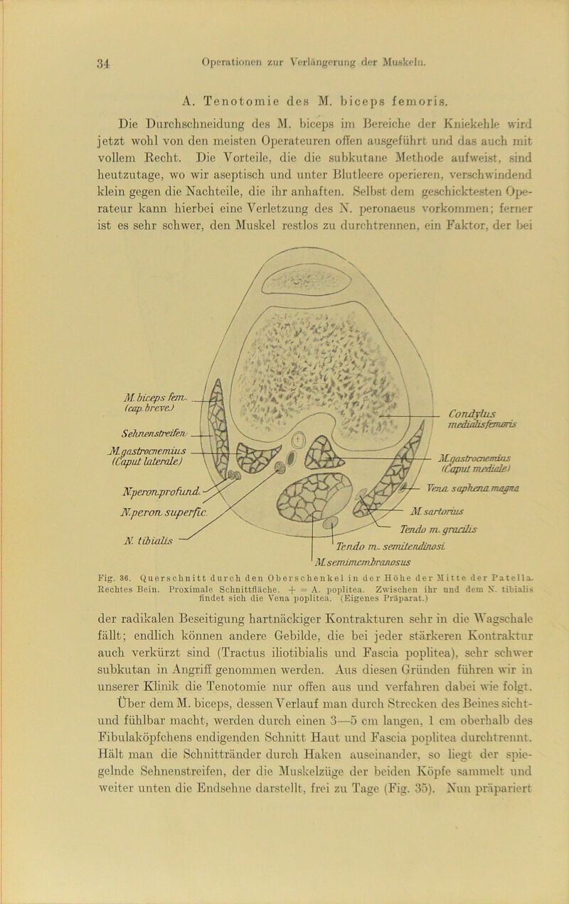 A. Tenotomie des M. biceps fenioris. Die Durclisclineidung des M. biceps iin Bereiche der Kniekehle wird jetzt wohl von den meisten Operateuren offen ausgeführt und das auch mit vollem Recht. Die Vorteile, die die subkutane Methode aufweist, sind heutzutage, wo wir aseptisch und unter Blutleere operieren, verschwindend klein gegen die Nachteile, die ihr anhaften. Selbst dem geschicktesten Ope- rateur kann hierbei eine Verletzung des N. peronaeus Vorkommen; ferner ist es sehr schwer, den Muskel restlos zu durchtrennen, ein Faktor, der bei Fig. 36. Querschnitt durch den Oberschenkel in der Höhe der Jlitte der Patella. Rechtes Bein. Proximale Schnittfläche. -(- = A. i)oi)litea. Zwischen ihr und dem X. tibi.alis findet sich die Vena poplitea. (Eigenes Präparat.) der radikalen Beseitigung hartnäckiger Kontrakturen sehr in die Wagschale fällt; endlich können andere Gebilde, die bei jeder stärkeren Kontraktur auch verkürzt sind (Tractus iliotibialis und Fascia poplitea), sehr schwer subkutan in Angriff genommen werden. Aus diesen Gründen füliren wir in unserer Klinik die Tenotomie nur offen aus und verfahren dabei wie folgt. Über dem M. biceps, dessen Verlauf man durch Strecken des Beines sicht- und fühlbar macht, werden durch einen 3—5 cm langen, 1 cm oberhalb des Fibulaköpfchens endigenden Schnitt Haut und Fascia poplitea durchtrennt. Hält man die Schnittränder durch Haken auseinander, so liegt der spie- gelnde Sehnenstreifen, der die Muskelzüge der beiden Köpfe sammelt und weiter unten die Endsehne darstellt, frei zu Tage (Fig. 35). Nun präpariert M. biceps Feirv. (cap. hrcve.) SehnenstrdfeTi M. gastrocnemiiis (Caput laterale) N. pewTLprofund. N.peroTL superfic. N. tibialts Condjhts TTiedtatisfiTTunis Maastrocnemiiis (CapuL mediale) Yena sapberuLmagna M. sartoräis Tendo m .grahlis Tenda m,. semilendinosi AL semimemiraiwsus