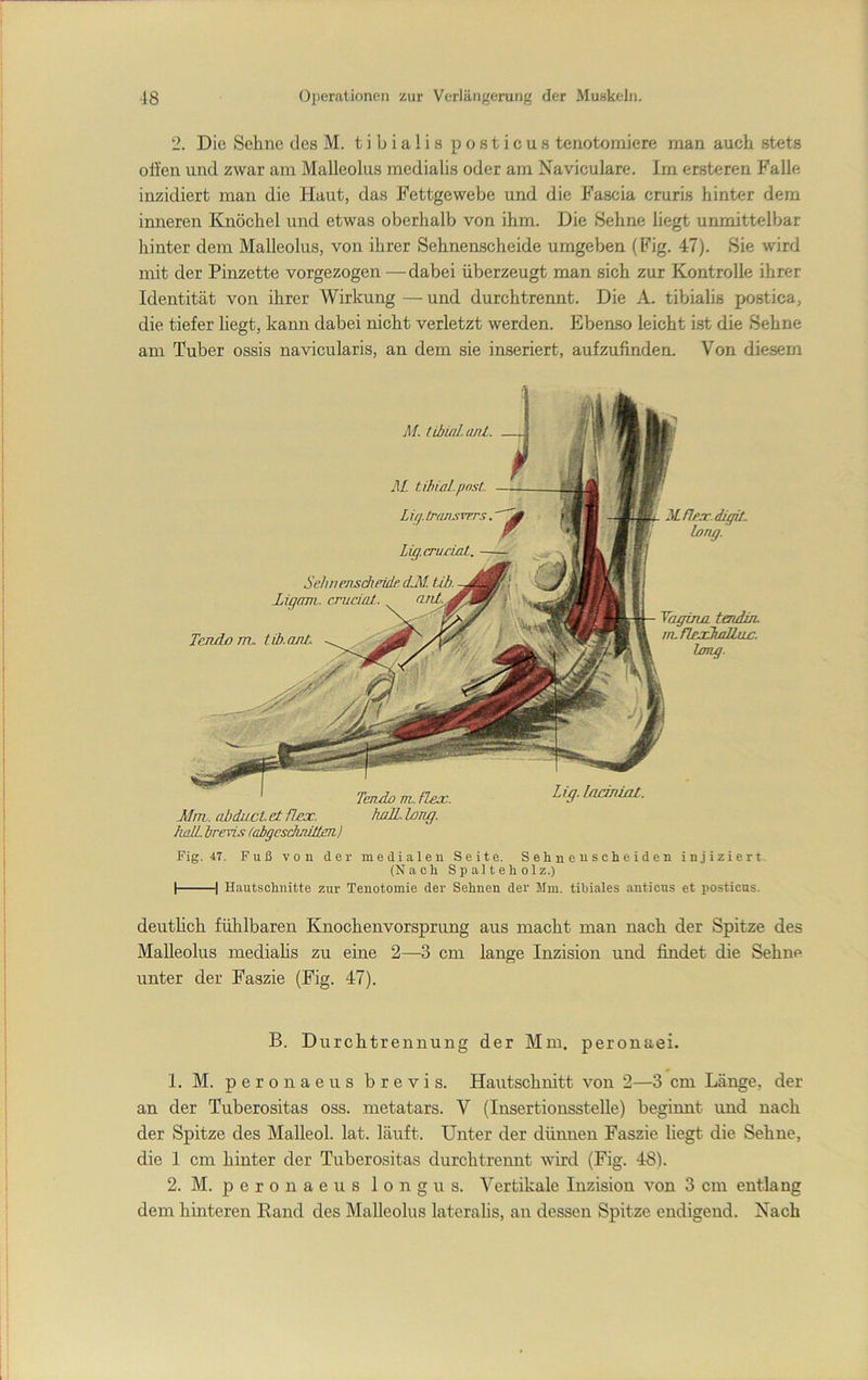 2. Die Sehne des M. t i b i a 1 i s p o s t i c u s tenotomiere man auch stets oli’en und zwar am Malleolus medialis oder am Naviculare. Im ersteren Falle inzidiert man die Haut, das Fettgewebe und die Fascia cruris hinter dem inneren Knöchel und etwas oberhalb von ihm. Die Sehne liegt unmittelbar hinter dem Malleolus, von ihrer Sehnenscheide umgeben (Fig. 47). Sie wird mit der Pinzette vorgezogen —dabei überzeugt man sich zur Kontrolle ihrer Identität von ihrer Wirkung — und durchtrennt. Die A. tibialis postica, die tiefer hegt, kann dabei nicht verletzt werden. Ebenso leicht ist die Sehne am Tuber ossis navicularis, an dem sie inseriert, aufzufinden. Von diesem Mflpjc.diffit. hng.' Tagina. tendin. m.f2ejJinllac. Img. Tendo m. fLex. Mm. abduct. et ilex. hall. long. haä. irevu; (abgcsdinülen) Fig. 47. Fuß von der medialen Seite. Sehnenscheiden (Nach Spalteholz.) I 1 Hautschnitte zur Tenotomie der Sehnen der Mm. tibiales anticus injiziert, et posticus. M. tibüd.ant. M tiHül.post. Lig./ransvers. Lig.cruriMl. — Sehiiensdieide dJd. tih. Jjigani. cruciat. Tendo m. tib.anb. deutheh fühlbaren Knochenvorsprung aus macht man nach der Spitze des Malleolus mediahs zu eine 2—3 cm lange Inzision und findet die Sehne unter der Faszie (Fig. 47). B. Durchtrennung der Mm. peronaei. 0 1. M. peronaeus brevis. Hautschnitt von 2—3 cm Länge, der an der Tuberositas oss. metatars. V (Insertionsstelle) beginnt und nach der Spitze des Malleol. lat. läuft. Unter der dünnen Faszie liegt die Sehne, die 1 cm hinter der Tuberositas durch trennt wird (Fig. 48). 2. M. p e r 0 n a e u s 1 o n g u s. Vertikale Inzision von 3 cm entlang dem hinteren Rand des Malleolus lateralis, an dessen Spitze endigend. Nach