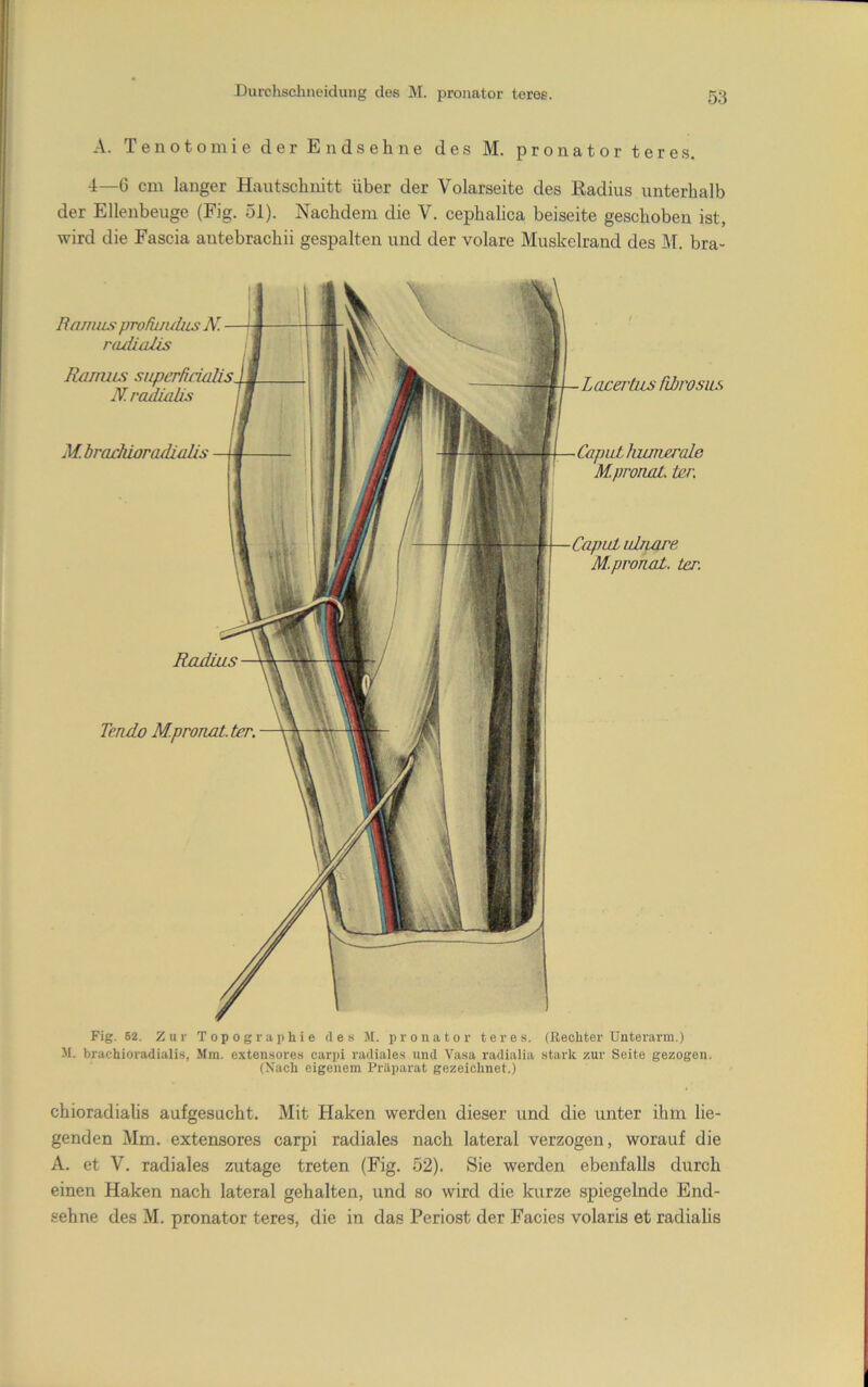 Durchsclmeiclung des M. pronator teree. A. Tenotomie der Endsehne des M. pronator teres. 4—6 cm langer Hautschnitt über der Volarseite des Radius unterhalb der Ellenbeuge (Fig. 51). Nachdem die V. cephalica beiseite geschoben ist, wird die Fascia antebrachii gespalten und der volare Muskelrand des M. bra- Radius Ranuus profiuuüts N. radialis Ranuus superfinalis N.radiaäs M. brachioradialis Tendo M.proiiat. ter. Lacerbis fibrosius Caput hunierale MpronoL Ur. Fig. 62. Zur Topographie des M. pronator teres. (Rechter Unterarm.) M. brachioradialis, Mm. extensores carpi radiales und Vasa radialia stark zur Seite gezogen. (Xach eigenem Prilparat gezeichnet.) chioradialis aufgesucht. Mit Haken werden dieser und die unter ihm lie- genden Mm. extensores carpi radiales nach lateral verzogen, worauf die A. et V. radiales zutage treten (Fig. 52). Sie werden ebenfalls durch einen Haken nach lateral gehalten, und so wird die kurze spiegelnde End- sehne des M. pronator teres, die in das Periost der Facies volaris et radialis