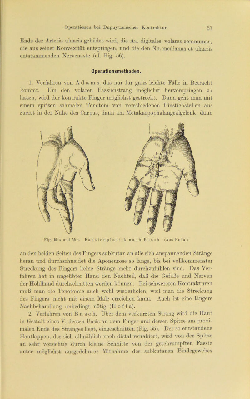 Ende der Arteria ulnaris gebildet wird, die Aa. digitales volares coinimmes, die aus seiner Konvexität entspringen, und die den Nn. medianus et ulnaris entstammenden Nervenäste (cf. Fig. 56). Operationsmethoden. 1. Verfahren von Adams, das nur für ganz leichte Fälle in Betracht konmit. Um den volaren Faszienstrang möglichst hervorspringen zu lassen, wird der kontrakte Finger möglichst gestreckt. Dann geht man mit einem spitzen schmalen Tenotom von verschiedenen Einstichstellen aus zuerst in der Nähe des Carpus, dann am Metakarpophalangealgelenk, dann Fig. Bo a und 55 b. Faszien plastik nach Busch. (Aus Holfa.) an den beiden Seiten des Fingers subkutan an alle sich anspannenden Stränge heran und durchschneidet die Aponeurose so lange, bis bei vollkommenster Streckung des Fingers keine Stränge mehr durchzufühlen sind. Das Ver- fahren hat in ungeübter Hand den Nachteil, daß die Gefäße und Nerven der Hohlhand durchschnitten werden können. Bei schwereren Kontrakturen muß man die Tenotomie auch wohl wiederholen, weil man die Streckung des Fingers nicht mit einem Male erreichen kann. Auch ist eine längere Nachbehandlung unbedingt nötig (Hoff a). 2. Verfahren von Busch. Über dem verkürzten Strang wird die Haut in Gestalt eines V, dessen Basis an dem Finger und dessen Spitze am proxi- malen Ende des Stranges liegt, eingeschnitten (Fig. 55). Der so entstandene Hautlappen, der sich allmählich nach distal retrahiert, wird von der Spitze an sehr vorsichtig durch kleine Schnitte von der geschrumpften Faszie unter möglichst ausgedehnter Mitnahme des subkutanen Bindegewebes