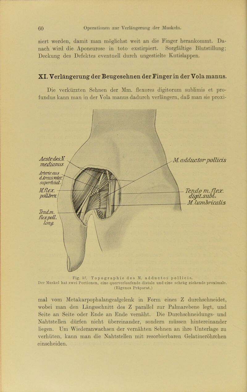 siert werden, damit man möglichst weit an die Finger herankommt. Da- nach wird die Aponeurose in toto exstirpiert. Sorgfältige Blutstillung; Deckung des Defektes eventuell durch ungestielte Kutislappen. XI. Verlängerung der Beugesehnen der Finger in der Vola manus. Die verkürzten Sehnen der Mm. flexores digitorum sublimis et pro- fundus kann man in der Vola manus dadurch verlängern, daß man sie proxi- AestedesN. mjedimms IrterieaiLs superUddl. Mflex. polLbrev. M. a/Lductor poUlcis TeruLo nt. fLex. digiLsubl. M.himirimlis Fig. 57. Topographie des M. a d d u o t o r p o 11 i c i s. Der Muskel hat zwei Portiouen, eine querverlaufende distale und eine .schräg ziehende proximale. (Eigenes Präparat.) mal vom Metakarpophalangealgelenk in Form eines Z durchschneidet, wobei man den Längsschnitt des Z parallel zur Palmarebene legt, und Seite an Seite oder Ende an Ende vernäht. Die Durchschneiduugs- und Nahtstellen dürfen nicht übereinander, sondern müssen hintereinander liegen. Um Wiederanwachsen der vernähten Sehnen an ihre Unterlage zu verhüten, kann man die Nahtstellen mit resorbierbaren Gelatineröhrcheu cinscheiden.