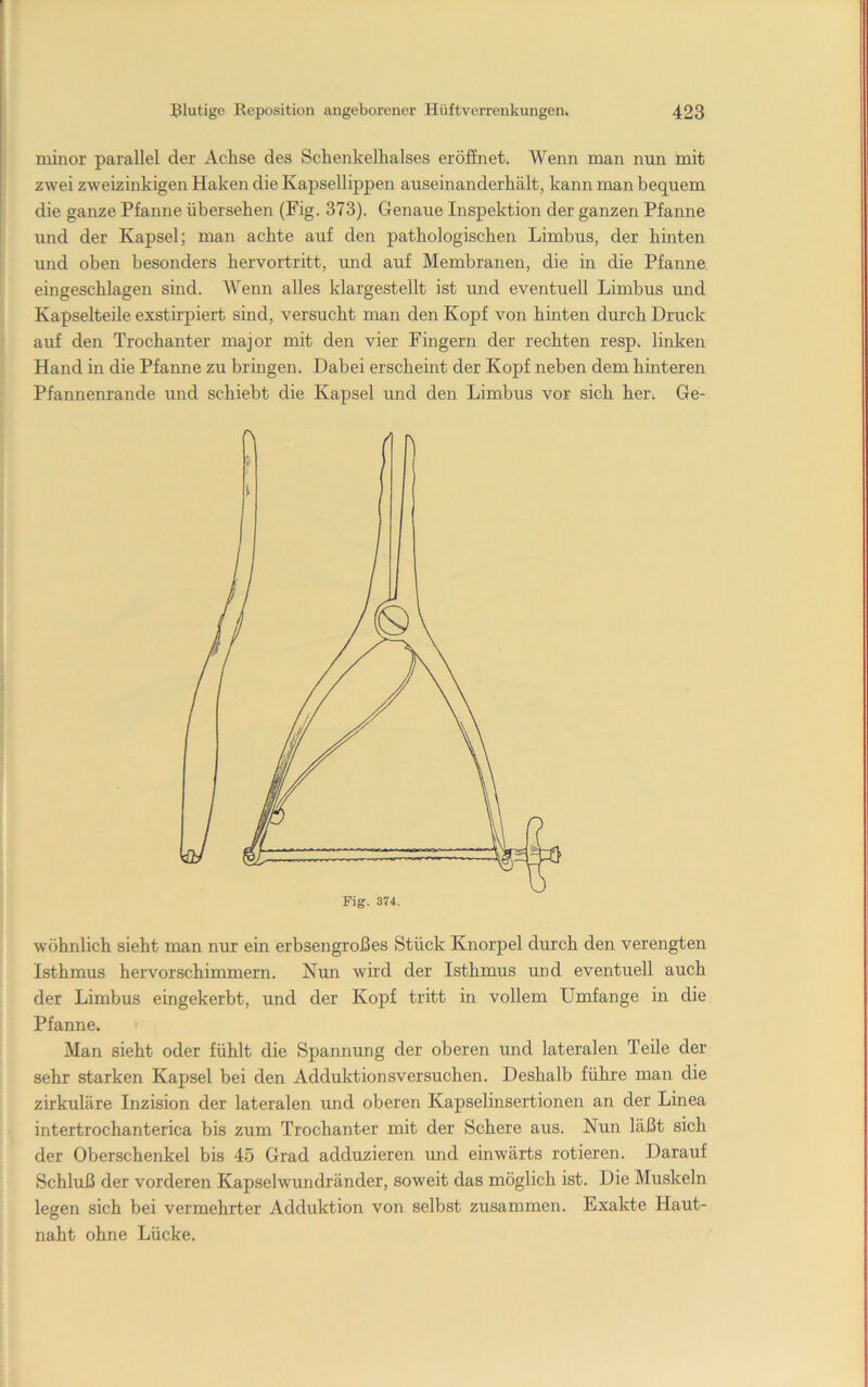 niiitor parallel der Achse des Schenkelhalses eröfEnet. AVenn man nun mit zwei zweizinkigen Haken die Kapsellippen auseinanderhält, kann man bequem die ganze Pfanne übersehen (Fig. 373). Genaue Inspektion der ganzen Pfanne rmd der Kapsel; man achte auf den pathologischen Limbus, der hinten und oben besonders hervortritt, rmd auf Membranen, die in die Pfanne eingeschlagen sind. AVenn alles klargestellt ist und eventuell Limbus tmd Kapselteile exstirpieii; sind, versucht man den Kopf von hinten durch Druck auf den Trochanter major mit den vier Fingern der rechten resp. linken Hand in die Pfamie zu bringen. Dabei erscheint der Kopf neben dem hinteren Pfannenrande und schiebt die Kapsel und den Limbus vor sich her. Ge- wöhnlich sieht man nur ein erbsengroßes Stück Knorpel durch den verengten Isthmus hervorschimmern. Nun wird der Isthmus und eventuell auch der Limbus eingekerbt, und der Kopf tritt in vollem Umfange in die Pfanne. Man sieht oder fühlt die Spannung der oberen und lateralen Teile der sehr starken Kapsel bei den Adduktionsversuchen. Deshalb führe man die zirkuläre Inzision der lateralen und oberen Kapselinsertionen an der Linea intertrochanterica bis zum Trochanter mit der Schere aus. Nun läßt sich der Oberschenkel bis 45 Grad adduzieren und einwärts rotieren. Darauf Schluß der vorderen Kapselwundränder, soweit das möglich ist. Die Muskeln legen sich bei vermehrter Adduktion von selbst zusammen. Exakte Haut- naht ohne Lücke.
