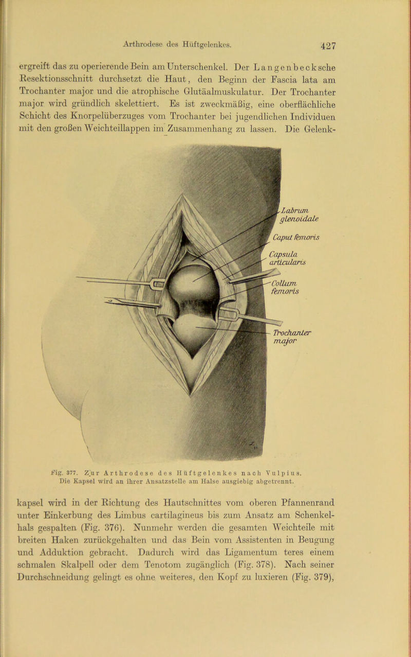 ergreift das zu operierende Bein am Unterschenkel. Der Langenbeck sehe Resektionsschnitt durchsetzt die Haut, den Beginn der Fascia lata am Trochanter major und die atrophische Glutäalmuskulatur. Der Trochanter major wird gründlich skelettiert. Es ist zweckmäßig, eine oberflächliche Schicht des Knorpelüberzuges vom Trochanter bei jugendlichen Individuen mit den großen Weichteillappen im Zusammenhang zu lassen. Die Gelenk- f’ig. 377. Z'u r Arthrodese des Hüftgelenkes nach Vulpius. Die Kapsel wird an ihrer Ansatzstelle am Halse ausgiebig abgetrennt. kapsel wird in der Richtung des Hautschnittes vom oberen Pfannenrand unter Einkerbung des Limbus cartilagineus bis zum Ansatz am Schenkel- hals gespalten (Fig. 376). Nunmehr werden die gesamten Weichteile mit breiten Haken zurückgehalten und das Bein vom Assistenten in Beugung und Adduktion gebracht. Dadurch wird das Ligamentum teres einem schmalen Skalpell oder dem Tenotom zugänglich (Fig. 378). Nach seiner Durchschneidung gelingt es ohne weiteres, den Kopf zu luxieren (Fig. 379), Trochjonter meyor Labruin gLerwidale Capul fenioris Capsula orticularLs Collum fenioris