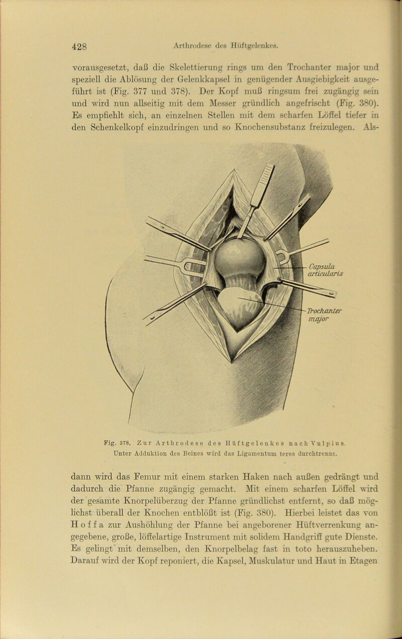 vorausgesetzt, daß die Skelettierung rings um den Trochanter major und speziell die Ablösung der Gelenkkapsel in genügender Ausgiebigkeit ausge- führt ist (Fig. 377 und 378). Der Kopf muß ringsum frei zugängig sein und wird nun allseitig mit dem Messer gründlich angefrischt (Fig. 380). Es empfiehlt sich, an einzelnen Stellen mit dem scharfen Löffel tiefer in den Schenkelkopf einzudringen und so Knochensubstanz freizulegen. Als- Capsula aräetdaris Troch/uiLer major Fig. 378. Zur Arthrodese des Hüftgelenkes nachVulpius. Unter Adduktion des Beines wird das Ligamentum teres durchtrenm. dann wird das Femur mit einem starken Haken nach außen gedrängt imd dadurch die Pfanne zugängig gemacht. Mit emem scharfen Löffel wird der gesamte Knorpelüberzug der Pfanne gründlichst entfernt, so daß mög- lichst überall der Knochen entblößt ist (Fig. 380). Hierbei leistet das von H 0 f f a zur Aushöhlung der Pfanne bei angeborener Hüftverrenkung an- gegebene, große, löffelartige Instrument mit solidem Handgriff gute Dienste. Es gehngt‘mit demselben, den Knorpelbelag fast in toto herauszuheben. Darauf wird der Kopf reponiert, die Kapsel, Muskulatur und Haut in Etagen