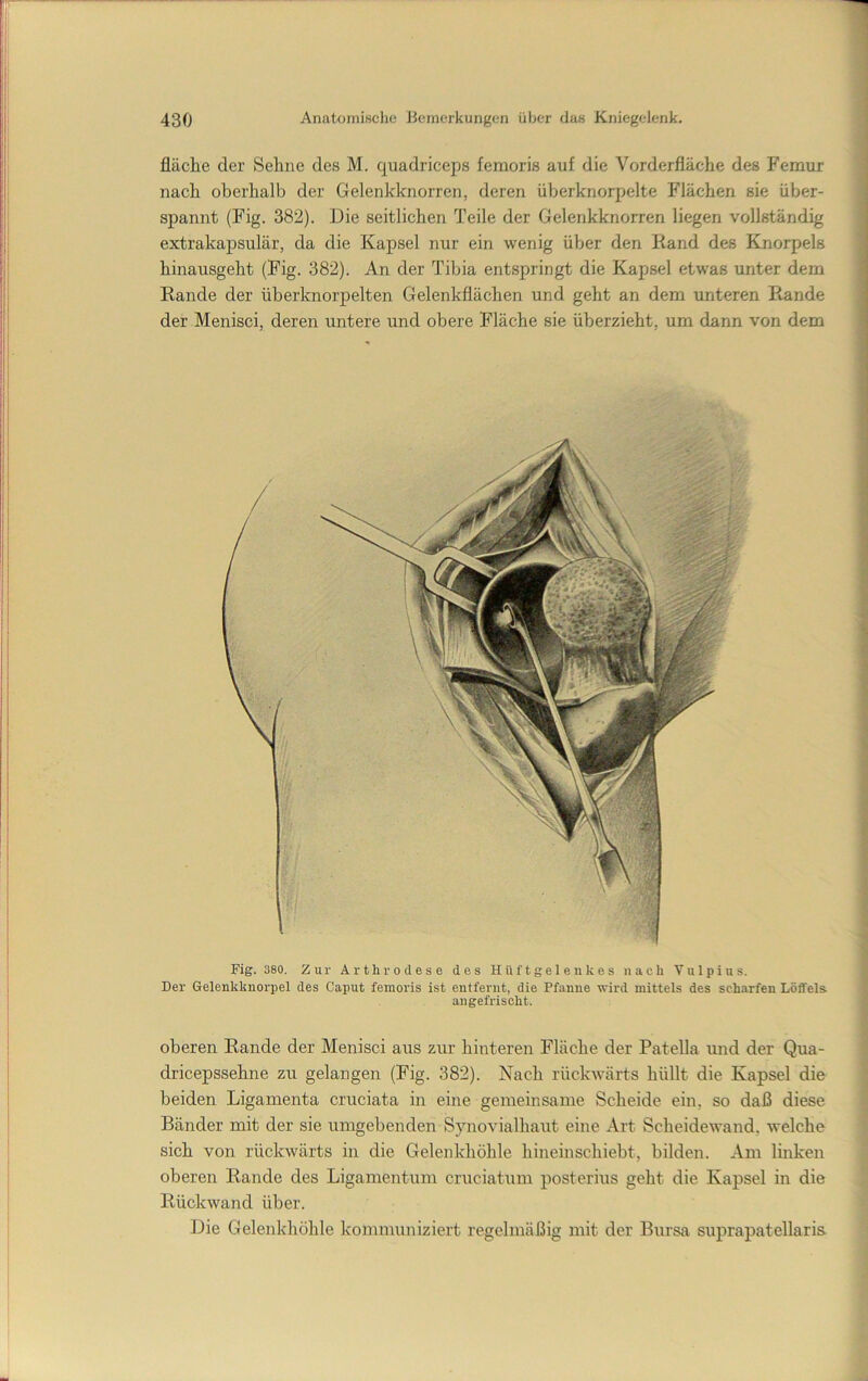 fläclie der Sehne des M. quadriceps femoris auf die Vorderfläche des Femur nach oberhalb der Gelenkknorren, deren überknorpelte Flächen sie über- spannt (Fig. 382). Die seitlichen Teile der Gelenkknorren liegen vollständig extrakapsulär, da die Kapsel nur ein wenig über den Rand des Knorpels hinausgeht (Fig. 382). An der Tibia entspringt die Kapsel etwas unter dem Rande der überknorpelten Gelenkflächen und geht an dem unteren Rande der Menisci, deren untere und obere Fläche sie überzieht, um dann von dem Fig. 380. Zur Arthrodese des Hüftgelenkes nach Vulpius. Der Gelenkknorpel des Caput femoris ist entfernt, die Pfanne wird mittels des scharfen Löffels angefrischt. oberen Rande der Menisci aus zur hinteren Fläche der Patella und der Qua- dricepssehne zu gelangen (Fig. 382). Nach rückwärts hüllt die Kapsel die beiden Ligamenta cruciata in eine gemeinsame Scheide ein, so daß diese Bänder mit der sie umgebenden Synovialhaut eine Art Scheidewand, welche sich von rückwärts in die Gelenkhöhle hineinschiebt, bilden. Am linken oberen Rande des Ligamentum cruciatum posterius geht die Kapsel in die Rückwand über. Die Gelenkhöhle kommuniziert regelmäßig mit der Bursa suprapatellaris