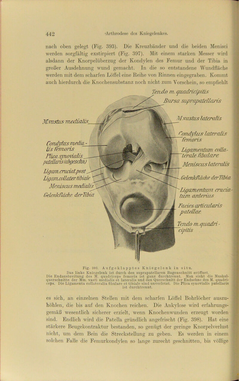 nach oben gelegt (Fig. 393). l.)ie Kreuzbänder und die beiden Menisci werden sorgfältig exstirpiert (Fig. 397). Mit einem starken Messer wird alsdann der Knorpelüberzug der Kondylen des Femur und der Tibia in großer Ausdehnung wund gemacht. In die so entstandene Wundfläche werden mit dem scharfen Löffel eine Reihe von Rinnen eingegraben. Kommt auch hierdurch die Knochensubstanz noch nicht zum Vorschein, so empfiehlt MTOstus Tri£diaKs__ Condylus nwäln- lis femoris PüccLsynovinlis patdlarLs(abgesclui) Ligam.crucial.post LiganhcolLatertiMcde Menisais mediaäs ^ Gelenkfläche derTibia im? Teadn m.. cfu/iäricipi/Li Bursa suprapaleJJ/iris M. vastus laleralis Conjdyius laleraäs . femoris Ligcuneiitum coUa.- leralc äbulare Meniscus lateralis Geleaknädip dcrTibui Ligamentimi emeia.- I tiun anterius Faeies aräcularis pateäae '^do m. qiLodri - cipiäs Fig. 390. Aufgeklapptes Kniegelenk in situ. Das linke Kniegelenk ist durch den suprapatellaren Bogenschnitt eröft'net. Die Endaushreitung des M. quadriceps femoris ist ganz durchtrennt. Man sieht die Muskel- quersohnitte der Mm. vasti medialis et lateralis und den Querschnitt der Endse.hnc des M. quadri- ceps. Die Ligamenta collateralia iibulare et tibiale sind unverletzt. Die Plica synovialis patellaris ist durchtrennt. es sich, an einzelnen Stellen mit dem scharfen Löffel Bohrlöcher auszu- höhlen, die bis auf den Knochen reichen. Die Ankylose wird erfahrungs- gemäß wesentlich sicherer erzielt, wenn Knochenwunden erzeugt worden sind. Endlich wird die Patella gründlich angefrischt (Fig. 398). Hat eine stärkere Beugekontraktur bestanden, so genügt der geringe Knorpelverlust nicht, um dem Bein die Streckstellung zu geben. Es werden in einem solchen Falle die Femurkondylen so lange zurecht geschnitten, bis völlige