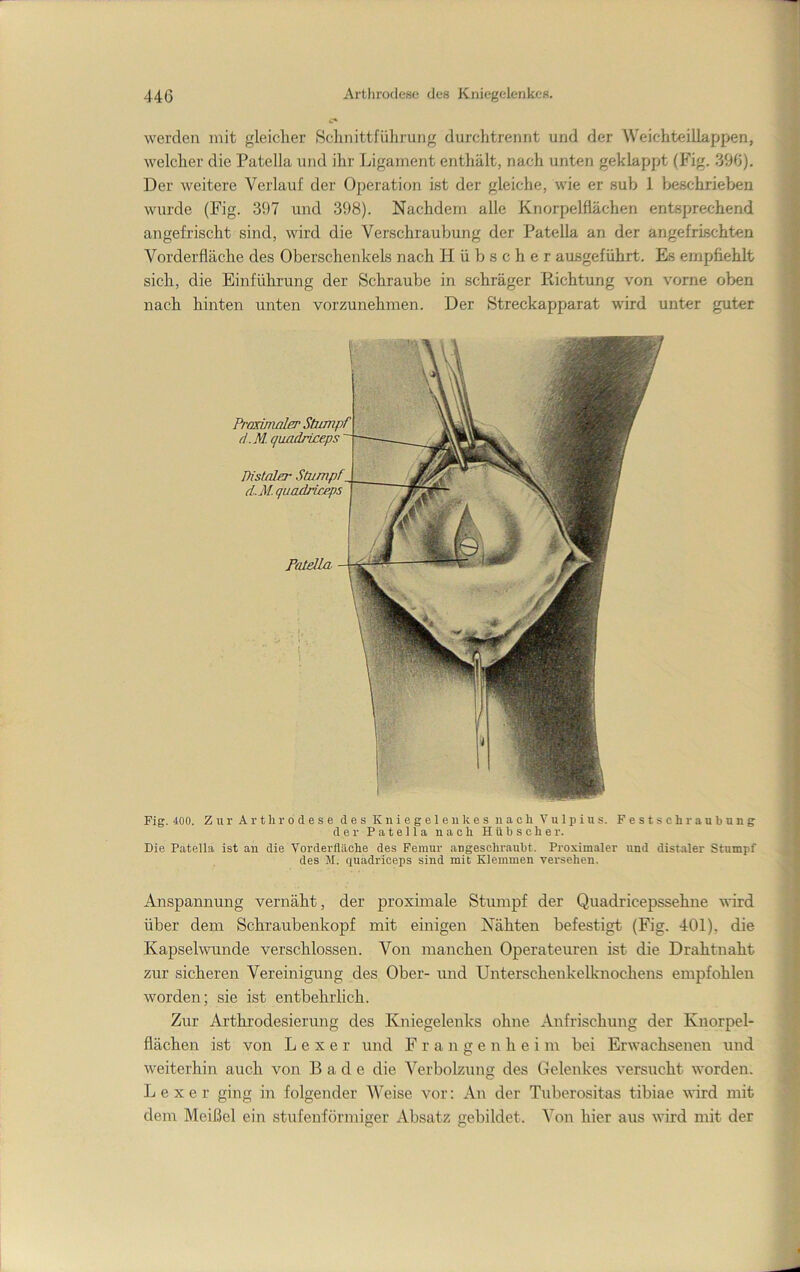 werden mit gleicher Schnittführung durchtreinit und der Weichteillappen, welcher die Patella und ihr Ligament enthält, nach unten geklappt (Fig. 390). Der weitere Verlauf der Operation ist der gleiche, wie er sub 1 beschrieben wurde (Fig. 397 und 398). Nachdem alle Knorpelflächen entsprechend angefrischt sind, wird die Verschraubung der Patella an der angefrischten Vorderfläche des Oberschenkels nach Hübscher ausgeführt. Es empfiehlt sich, die Einführung der Schraube in schräger Eichtung von vorne oben nach hinten unten vorzunehmen. Der Streckapparat wird unter guter Pranmaler d.M. JUst/üo' Stumpf (L.M. quadriceps F/Uella- Fig. 400. Zur Arthrodese des Kniegeleulies nacli Vulpius. Festschraubung der Patella nach Hübscher. Die Patella ist an die Vorderfläche des Femur angeschraubt. Proximaler und distaler Stumpf des M. quadriceps sind mit Klemmen versehen. Anspannung vernäht, der proximale Stumpf der Quadricepssehue wird über dem Schraubenkopf mit einigen Nähten befestigt (Fig. 401), die Kapselwunde verschlossen. Von manchen Operateuren ist die Drahtnaht zur sicheren Vereinigung des Ober- und Unterschenkelknochens empfohlen worden; sie ist entbehrlich. Zur Arthrodesierung des Kniegelenks ohne Anfrischung der Knorpel- flächen ist von L e X e r und F r a n g e n h e i m bei Erwachsenen und weiterhin auch von Bade die Verbolzung des Gelenkes versucht worden. L e X e r ging in folgender Weise vor: An der Tuberositas tibiae wird mit dem Meißel ein stufenförmiger Absatz gebildet. Von hier aus wird mit der