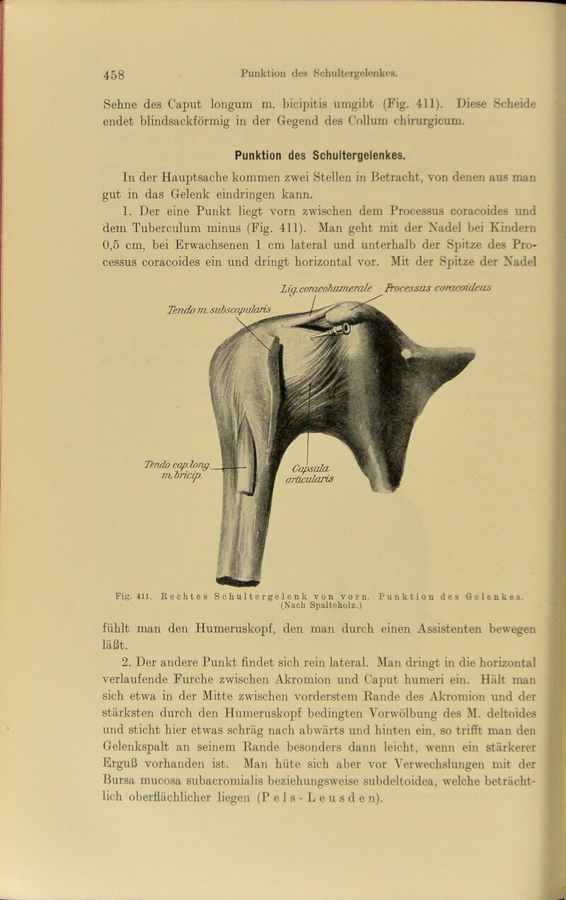 Sehne des Caput longum ni. bicipitis umgibt (Phg. 411). Diese Scheide endet blindsackförmig in der Gegend des Collum chirurgicum. Punktion des Schultergelenkes, In der Hauptsache kommen zwei Stellen in Betracht, von denen aus man gut in das Gelenk eindringen kann. 1. Der eine Punkt liegt vorn zwischen dem Processus coracoides und dem Tuberculum minus (Fig. 411). Man geht mit der Xadel bei Kindern 0,5 cm, bei Erwachsenen 1 cm lateral und unterhalb der Spitze des Pro- cessus coracoides ein und dringt horizontal vor. Mit der Spitze der Xadel Fig. 411. Eechtes Schultergeleuk von vorn. Punktion des Gelenkes. (Nach Spalteholz.) fühlt man den Humeruskopf, den man dm’ch einen Assistenten bewegen läßt. 2. Der andere Punkt findet sich rein lateral. Man dringt in die horizontal verlaufende Furche zwischen Akromion und Caput hiimeri ein. Hält man sich etwa in der Mitte zwischen vorderstem Hände des Akromion und der stärksten durch den Humeruskopf bedingten Yorwölbung des M. deltoides und sticht hier etwas schräg nach abwärts und hinten ein, so trifft man den Gelenkspalt an seinem Rande besonders dann leicht, wenn ein stärkerer Erguß vorhanden ist. Man hüte sich aber vor Verwechslungen mit der Bursa mucosa subacromialis beziehungsweise subdeltoidea, welche beträcht- lich oberflächlicher liegen (P e 1 s - L e u s d e n).