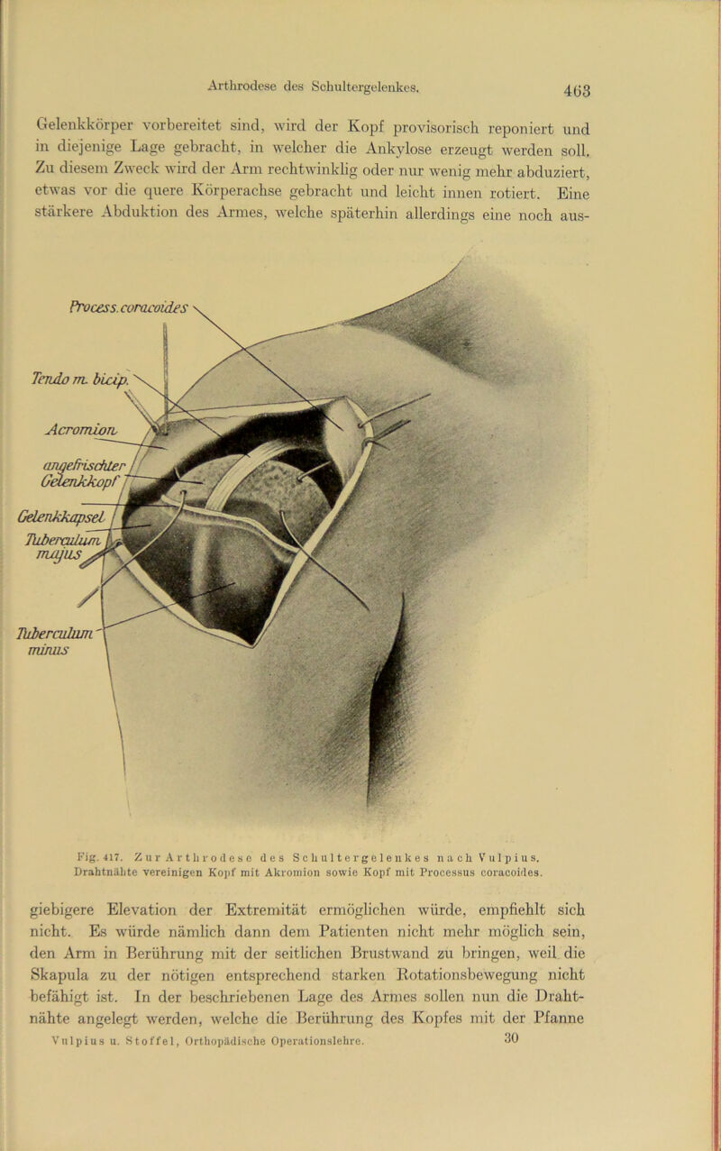 Gelenkkörper vorbereitet sind, wird der Kopf provisorisch reponiert und in diejenige Lage gebracht, in welcher die Ankylose erzeugt werden soll. Zu diesem Zweck wird der Arm rechtwinklig oder nur wenig mehr abduziert, etwas vor die quere Körperachse gebracht und leicht innen rotiert. Eine stärkere Abduktion des Armes, welche späterhin allerdings eine noch aus- Process. coracoides Tendo m, bLcip. AcrOTTLLOTL Gelenkkapsel Diberailuai Jhberailum miniis Fig. 417. Z u r A r t ln-o d e s e des S c h u 11 e r g e 1 e n k e s nachVulpius. DrahtnUlite vereinigen Kopf mit Akromion sowie Kopf mit Processus coracoides. giebigere Elevation der Extremität ermöglichen würde, empfiehlt sich nicht. Es würde nämlich dann dem Patienten nicht mehr möglich sein, den Arm in Berührung mit der seitlichen Bru,stwand zu bringen, weil die Skapula zu der nötigen entsprechend starken Kotationsbewegung nicht befähigt ist. In der beschriebenen Lage des Armes sollen nun die Draht- nähte angelegt werden, welche die Ikrührung des Kopfes mit der Pfanne V'ulpius u. Stoffel, Orthopildische Operationslelire. 30