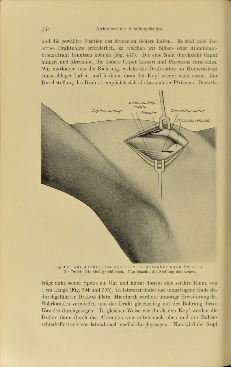 und die gewählte Position des Armes zu sichern haben. Es sind zwei der- artige Drahtnähte erforderlich, zu welchen wir Silber- oder Aluminium- bronzedraht benutzen können (Fig. 417). Die eine Naht durchzieht Caput humeri und Akromion, die andere Caput humeri und Processus coracoides. Wir markieren uns die Richtung, welche die Drahtnähte im Humeruskopf einzuschlagen haben, und luxieren dann den Kopf wieder nach vorne. Zur Durchstoßung des Drahtes empfiehlt sich ein besonderer Pfriemen. Derselbe Fig. 418. Zur Arthrodese des Schulter gelenkes nach Vulpius. Die Drahtnähte sind geschlossen. Man beachte die Stellung des .-Vrnies. trägt nahe seiner Spitze ein Öhr und hinter diesem eine seichte Rinne von 1 cm Länge (Fig. 394 und 395). In letzterer findet das umgebogene Ende des durchgeführten Drahtes Platz. Hierdurch wird die unnötige Erweiterung des Bohrkanales vermieden und der Draht gleichzeitig mit der Bohrung dieses Kanales durchgezogen. In gleicher Weise wie durch den Kopf werden die Drähte dann durch das Akromion von unten nach oben und am Raben- schnabelfortsatz von lateral nach medial durchgezogen. Nun wird der Kopf