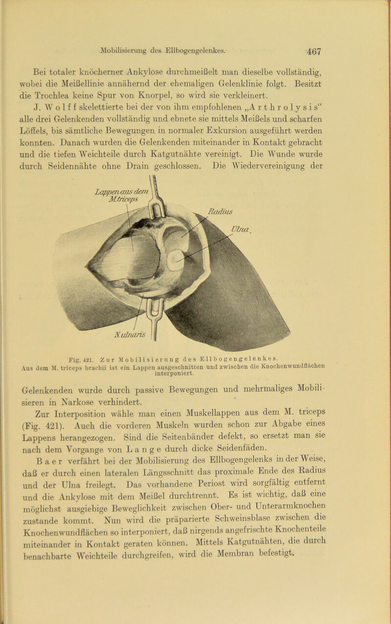 Bei totaler knöcherner Ankylose durchmeißelt man dieselbe vollständig, wobei die Meißellinie annähernd der ehemaligen Gelenklinie folgt. Besitzt die Trochlea keine Spur von Knorpel, so wird sie verkleinert. J. W o 1 f f skelettierte bei der von ihm empfohlenen „A r t h r o 1 y s i s“ alle drei Gelenkenden vollständig und ebnete sie mittels Meißels und scharfen Löffels, bis sämtliche Bewegungen in normaler Exkursion ausgeführt werden konnten. Danach wurden die Gelenkenden miteinander in Kontakt gebracht und die tiefen Weichteile durch Katgutnähte vereinigt. Die Wunde wurde durch Seidennähte ohne Drain geschlossen. Die Wiedervereinigung der Fig. 421. Zur Mobilisierung des Ellbogengeleiikes. ■■Vus dem M. triceps braebii ist ein Lappen ausgeschnitten und zwischen die Knochenwimdflächen interponiert. Gelenkenden wurde durch passive Bewegungen und mehrmaliges Mobili- sieren in Narkose verhindert. Zur Interposition wähle man einen Muskellappen aus dem M. triceps (Fig. 421). Auch die vorderen Muskeln wurden schon zur Abgabe eines Lappens herangezogen. Sind die Seitenbänder defekt, so ersetzt man sie nach dem Vorgänge von Lange durch dicke Seidenfäden. B a e r verfährt bei der Mobilisierung des Ellbogengelenks in der Weise, daß er durch einen lateralen Längsschnitt das proximale Ende des Radius und der Ulna freilegt. Das vorhandene Periost wird sorgfältig entfernt und die Ankylose mit dem Meißel durchtrennt. Es ist wichtig, daß eine möglichst ausgiebige Bew^eglichkeit zwischen Ober- und Unterarmknochen zustande kommt. Nun wird die präparierte Schweinsblase zwischen die Knochenwundflächen so interponiert, daß nirgends angefrischte Knochenteile miteinander in Kontakt geraten können. Mittels Katgutnähten, die durch benachbarte Weichteile durchgreifen, wird die Membran befestigt.