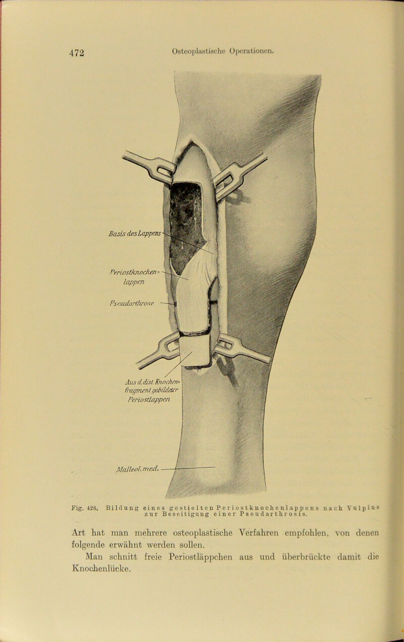 Basis des Lappens Periostknochjen lappen Pseudarlhrose Aus d. dM Krincherf rragmenl gebildeter PeriostLappen MaJleal. me/L Fig. 426. Bildung eines gestielten Peviostknoohenlappens nach Yulpius zur Beseitigung einer P s e u d ar t h r o s i s. Art hat man mehrere osteoplastische Verfahren empfohlen, von denen folgende erwähnt werden sollen. Man schnitt freie Periostläppchen aus und überbrückte damit die Knochenlücke.