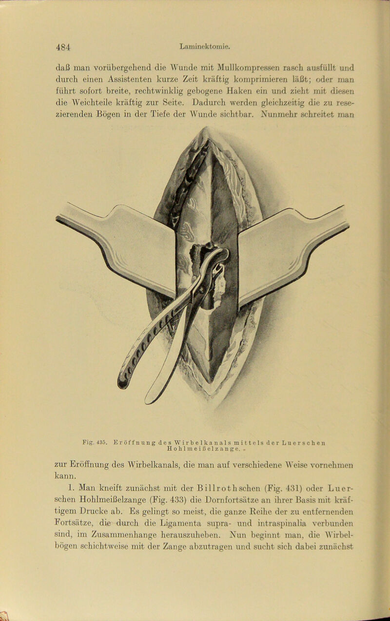 daß man vorübergehend die Wunde mit Mullkompressen rasch ausfüllt und durcli einen Assistenten kurze Zeit kräftig komprimieren läßt; oder nmn führt sofort breite, rechtwinklig gebogene Haken ein und zieht mit diesen die Weichteile kräftig zur Seite. Dadurch werden gleichzeitig die zu rese- zierenden Bögen in der Tiefe der Wunde sichtbar. Nunmehr schreitet man Fig. 435. Eröffnung des W i r b e 1 k a n a 1 s mittels der Lu e r s c h e n H 0 h 1 m e i ß e 1 z a n g e. . zur Eröffnung des Wirbelkanals, die man auf verschiedene Weise vornehmen kann. 1. Man kneift zunächst mit der B illroth sehen (Fig. 431) oder Lu er- sehen Hohlmeißelzange (Fig. 433) die Dornfortsätze an ihrer Basis mit kräf- tigem Drucke ab. Es gelingt so meist, die ganze Reihe der zu entfernenden Fortsätze, die dui’ch die Ligamenta supra- und intraspinalia verbunden sind, im Zusammenhänge herauszuheben. Nun beginnt man, die Wirbel- bögen schichtweise mit der Zange abzutragen und sucht sich dabei zunächst