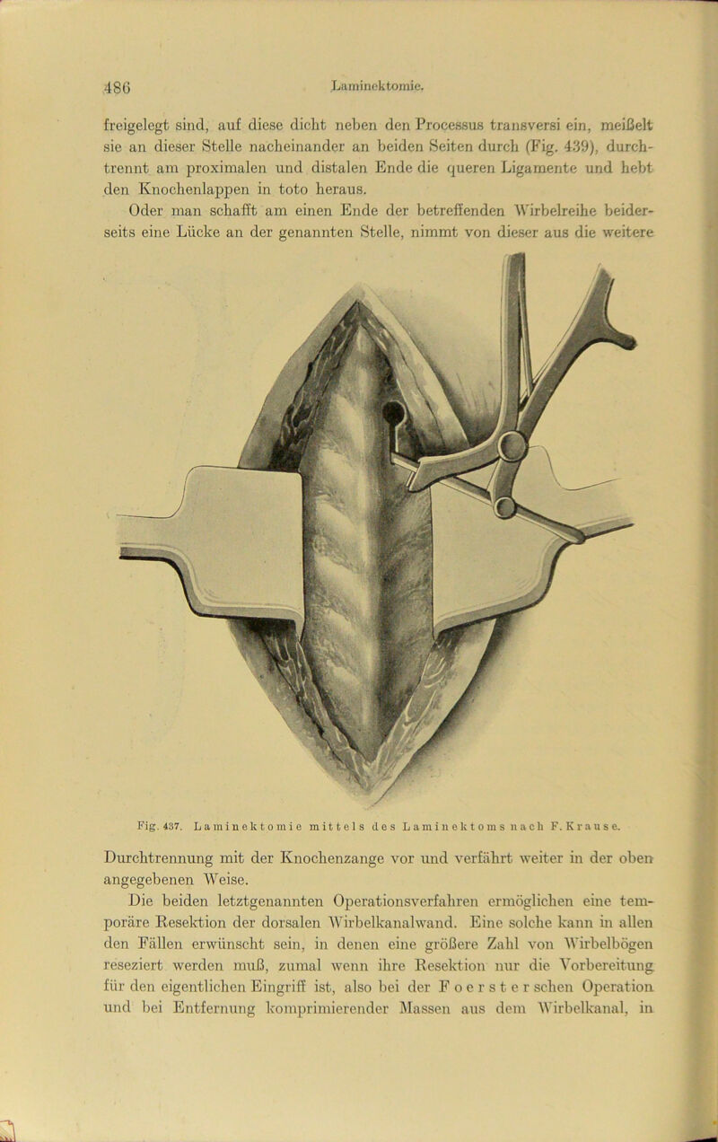 Durchtrennung mit der Knochenzange vor und verfährt weiter in der oben angegebenen Weise. Die beiden letztgenannten Operationsverfahren ermöglichen eine tem- poräre Reselction der dorsalen Wirbelkanalwand. Eine solche kann in allen den Fällen erwünscht sein, in denen eine größere Zahl von Wirbelbögen reseziert werden muß, zuiual wenn ihre Reselction nur die Vorbereitung für den eigentlichen Eingriff ist, also bei der Foerster sehen Operation und bei Entfernung komprimierender Älassen aus dem Wirbelkanal, in freigelegt sind, auf diese dicht neben den Processus transversi ein, meißelt sie an dieser Stelle nacheinander an beiden Seiten durch (Fig. 439), durch- trennt am proximalen und distalen Ende die queren Ligamente und hebt den Knochenlappen in toto heraus. Oder man schafft am einen Ende der betreffenden Wirbelreihe beider- seits eine Lücke an der genannten Stelle, nimmt von dieser aus die weitere